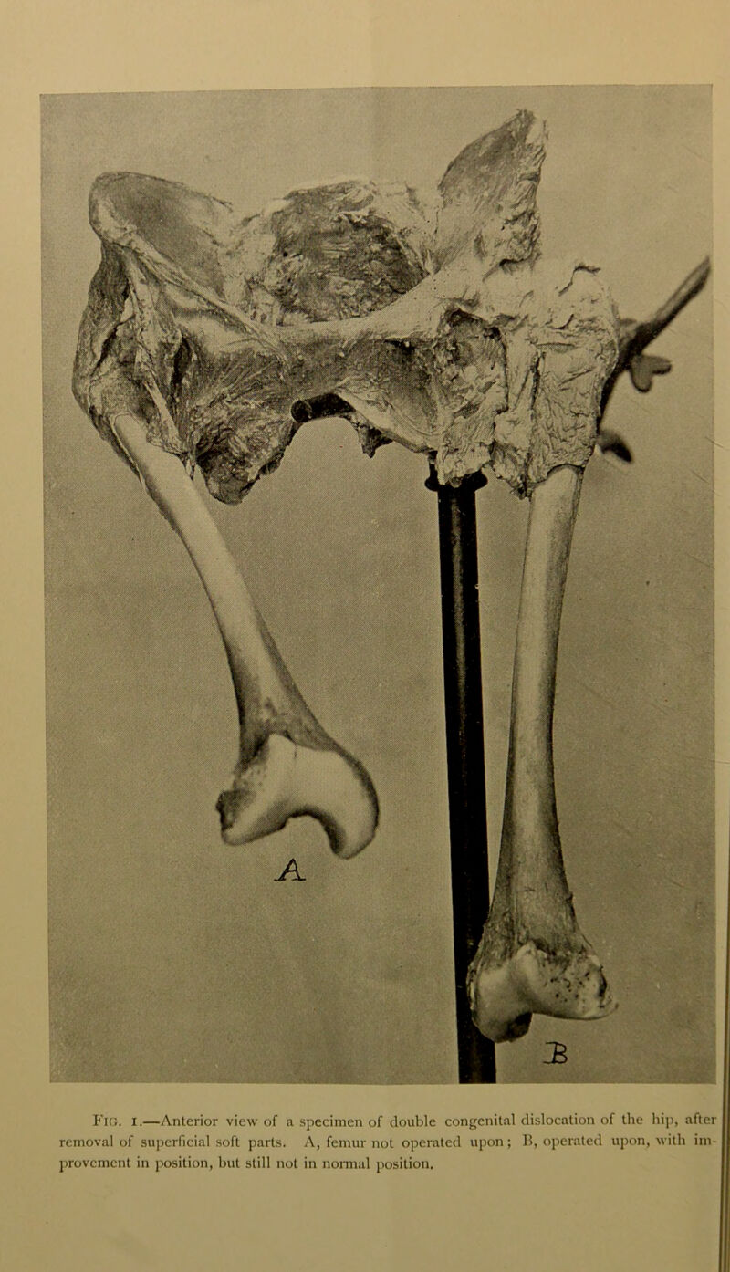 Fig. I.—Anterior view of a specimen of double congenital dislocation of the hip, after removal of superficial soft parts. A, femur not operated upon; B, operated upon, with im- provement in position, but still not in normal position.