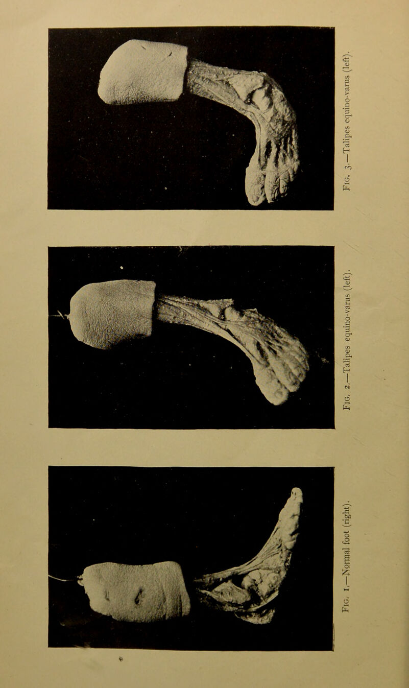 Fig. I,—>)prrn2ll foot (right), Fig, 2.—Talipes equino-varus (left). Fig. 3.—Talipes equino-vanis (left).