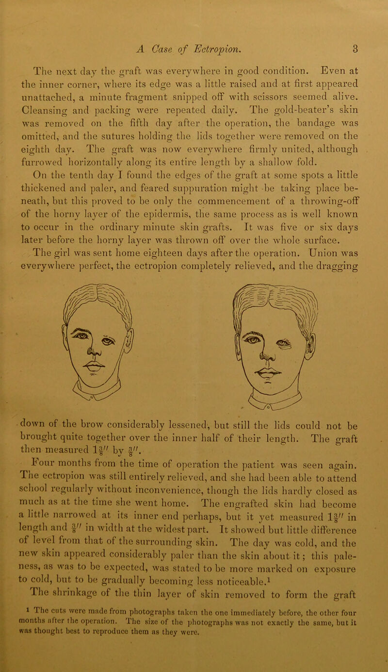 The next day the graft was everywhere in good condition. Even at the inner corner, where its edge was a little raised and at first appeared unattached, a minute fragment snipped off with scissors seemed alive. Cleansing and packing were repeated daily. The gold-beater’s skin was removed on the fifth day after the operation, the bandage was omitted, and the sutures holding the lids together were removed on the eighth day. The graft was now everywhere firmly united, although furrowed horizontally along its entire length by a shallow fold. On the tenth day I found the edges of the graft at some spots a little thickened and paler, and feared suppuration might be taking place be- neath, but this proved to be only the commencement of a throwing-off of the horny layer of the epidermis, the same process as is well known to occur in the ordinary minute skin grafts. It was five or six days later before the horny layer was thrown off over the whole surface. The girl was sent home eighteen days after the operation. Union was everywhere perfect, the ectropion completely relieved, and the dragging - down of the brow considerably lessened', but still the lids could not be brought quite together over the inner half of their length. The graft then measured If by f'b hour months from the time of operation the patient was seen again. Tne ectropion was still entirely relieved, and she had been able to attend school regularly without inconvenience, though the lids hardly closed as much as at the time she went home. The engrafted skin had become a little narrowed at its inner end perhaps, but it yet measured in length and § in width at the widest part. It showed but little difference of level from that of the surrounding skin. The day was cold, and the new skin appeared considerably paler than the skin about it; this pale- ness, as was to be expected, was stated to be more marked on exposure to cold, but to be gradually becoming less noticeable.1 The shrinkage of the thin layer of skin removed to form the graft i Ihe cuts were made from photographs taken the one immediately before, the other four months after the operation. The size of the photographs was not exactly the same, but it was thought best to reproduce them as they were.