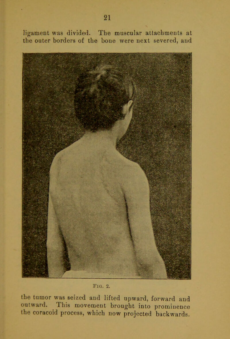 ligament was divided. The muscular attachments at the outer borders of the boue were next severed, aud Fig. 2. the tumor was seized aud lifted upward, forward and outward. This movement brought into prominence the coracoid process, which now projected backwards.