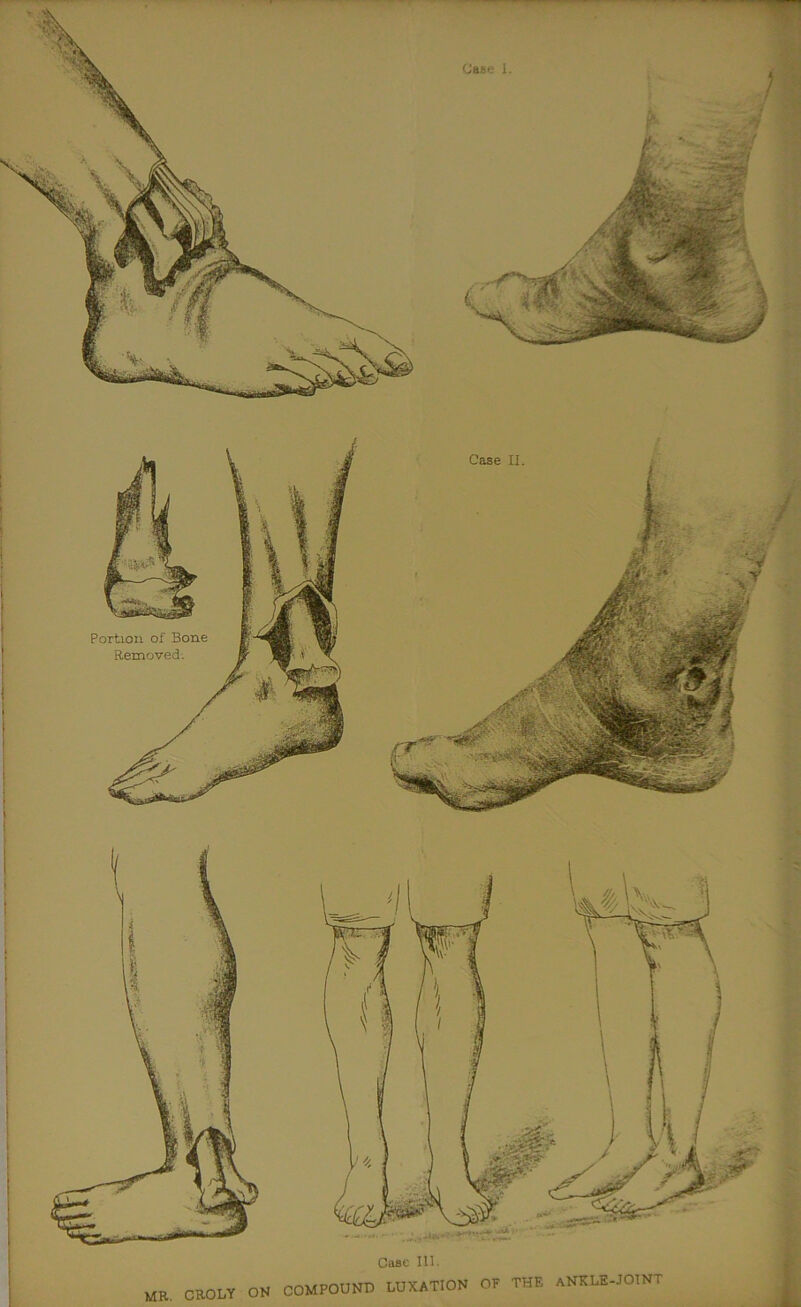 Portion of Bone Removed. -la.-' I /V 1 Wl J , A /i \ ii 1 a \ H j 1 H \ 1 J Case 111. MR. CR0LY ON COMPOUND LUXATION OF THE aNKLE-JOINT