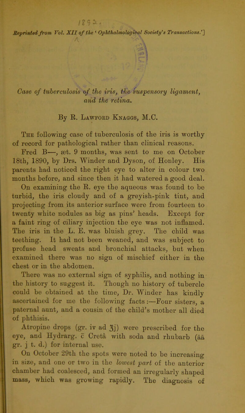 12 Reprinted from Vol. XII of the ( Ophthalmological Society's Transactions.'] i «••» > Case of tuberculosis of the iris, the suspensory ligament, and the retina. By R. Lawford Knaggs, M.C. The following case of tuberculosis of the iris is worthy of record for pathological rather than clinical reasons. Fred B—, get. 9 months, was sent to me on October 18th, 1890, by Drs. Winder and Dyson, of Honley. His parents had noticed the right eye to alter in colour two months before, and since then it had watered a good deal. On examining the R. eye the aqueous was found to be turbid, the iris cloudy and of a greyish-pink tint, and projecting from its anterior surface were from fourteen to twenty white nodules as big as pins5 heads. Except for a faint ring of ciliary injection the eye was not inflamed. The iris in the L. E. was bluish grey. The child was teething. It had not been weaned, and was subject to profuse head sweats and bronchial attacks, but when examined there was no sign of mischief either in the chest or in the abdomen. There was no external sign of syphilis, and nothing in the history to suggest it. Though no history of tubercle could be obtained at the time, Dr. Winder has kindly ascertained for me the following facts :—Four sisters, a paternal aunt, and a cousin of the child’s mother all died of phthisis. Atropine drops (gr. iv ad 3j) were prescribed for the eye, and Hydrarg. c Creta with soda and rhubarb (aa gr. j t. d.) for internal use. On October 29th the spots were noted to be increasing in size, and one or two in the lowest 2>art of the anterior chamber had coalesced, and formed an irregularly shaped mass, which was growing rapidly. The diagnosis of