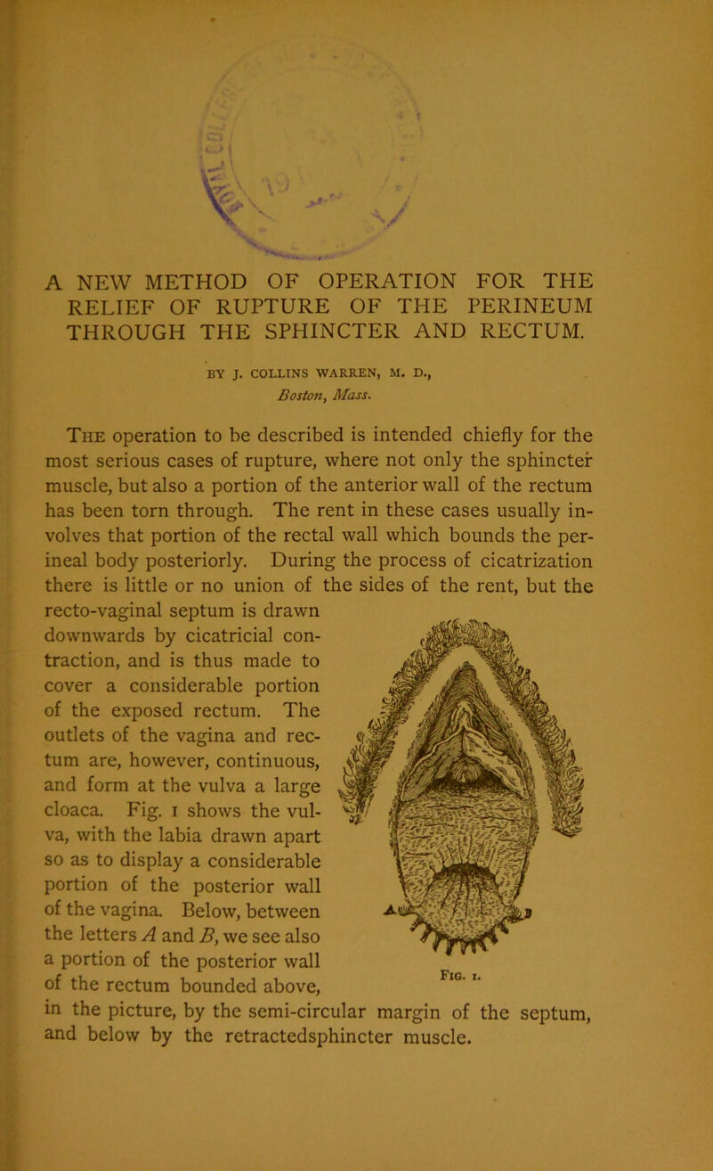 A NEW METHOD OF OPERATION FOR THE RELIEF OF RUPTURE OF THE PERINEUM THROUGH THE SPHINCTER AND RECTUM. BY J. COLLINS WARREN, M. D., Boston, Mass. The operation to be described is intended chiefly for the most serious cases of rupture, where not only the sphincter muscle, but also a portion of the anterior wall of the rectum has been torn through. The rent in these cases usually in- volves that portion of the rectal wall which bounds the per- ineal body posteriorly. During the process of cicatrization there is little or no union of the sides of the rent, but the recto-vaginal septum is drawn downwards by cicatricial con- traction, and is thus made to cover a considerable portion of the exposed rectum. The outlets of the vagina and rec- tum are, however, continuous, and form at the vulva a large cloaca. Fig. i shows the vul- va, with the labia drawn apart so as to display a considerable portion of the posterior wall of the vagina. Below, between the letters A and B, we see also a portion of the posterior wall of the rectum bounded above, in the picture, by the semi-circular margin of the septum, and below by the retractedsphincter muscle.