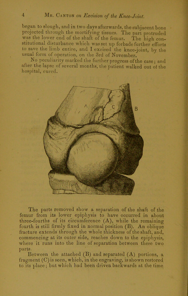 began to slough, and in two days afterwards, the subjacent bone projected through the mortifying tissues. Tlie part protruded was the lower end of the shaft of the femur. The high con- stitutional disturbance which was set up forbade further efforts to save the limb entire, and I excised the knee-joint, by the usual form of operation, on the 3rd of November. No peculiarity marked the further progress of the case; and after the lapse of several months, the patient walked out of the hospital, cured. The parts removed show a separation of the shaft of the femur from its lower epiphysis to have occurred in about three-fourths of its circumference (A), while the remaining fourth is still firmly fixed in normal position (B). An oblique fracture extends through the whole thickness of the shaft, and, commencing at its outer side, reaches down to the epiphysis, where it runs into the line of separation between these two parts. Between the attached (B) and separated (A) portions, a fragment (C)is seen, which, in the engraving, is shown restored to Its place; but which had been driven backwards at the time