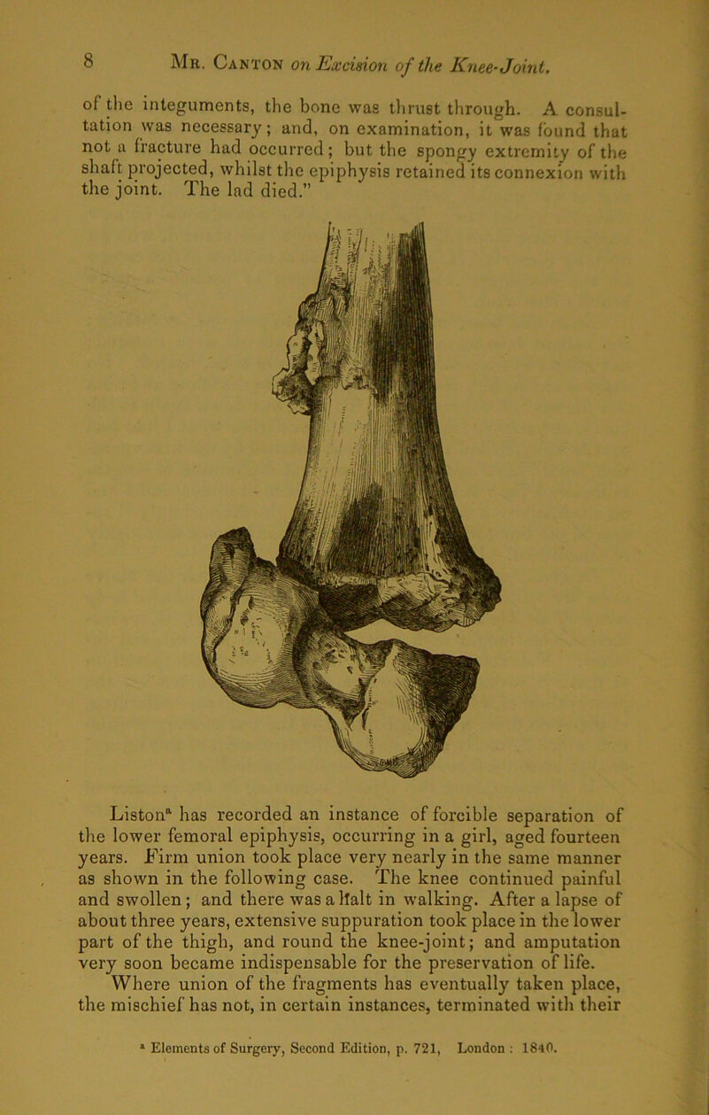 of the integuments, the bone was thrust through. A consul- tation was necessary; and, on examination, it was found that not a fracture had occurred; but the spongy extremity of the shaft projected, whilst the epiphysis retained its connexion with the joint. The lad died.” Liston® has recorded an instance of forcible separation of tlie lower femoral epiphysis, occurring in a girl, aged fourteen years. Firm union took place very nearly in the same manner as shown in the following case. The knee continued painful and swollen; and there was a halt in walking. After a lapse of about three years, extensive suppuration took place in the lower part of the thigh, and round the knee-joint; and amputation very soon became indispensable for the preservation of life. Where union of the fragments has eventually taken place, the mischief has not, in certain instances, terminated with their * Elements of Surgery, Second Edition, p. 721, London ; 1840.