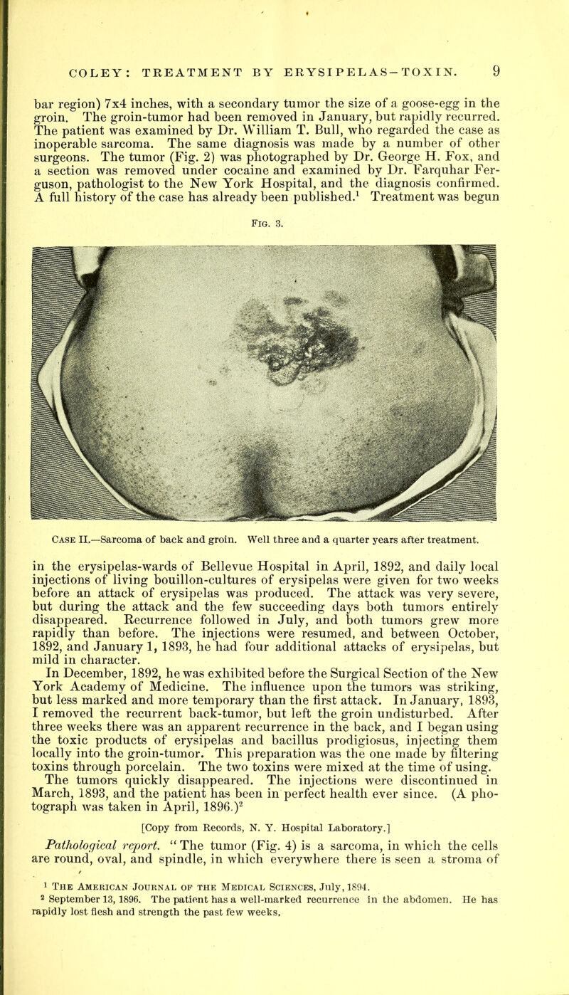bar region) 7x4 inches, with a secondary tumor the size of a goose-egg in the groin. The groin-tumor had been removed in January, but rapidly recurred. The patient was examined by Dr. William T. Bull, who regarded the case as inoperable sarcoma. The same diagnosis was made by a number of other surgeons. The tumor (Fig. 2) was photographed by Dr. George H. Fox, and a section was removed under cocaine and examined by Dr. Farquhar Fer- guson, pathologist to the New York Hospital, and the diagnosis confirmed. A full history of the case has already been published.^ Treatment was begun Fig. 3. Case II.—Sarcoma of back and groin. Well three and a quarter years after treatment. in the erysipelas-wards of Bellevue Hospital in April, 1892, and daily local injections of living bouillon-cultures of erysipelas were given for two weeks before an attack of erysipelas was produced. The attack was very severe, but during the attack and the few succeeding days both tumors entirely disappeared. Recurrence followed in July, and both tumors grew more rapidly than before. The injections were resumed, and between October, 1892, and January 1, 1893, he had four additional attacks of erysipelas, but mild in character. In December, 1892, he was exhibited before the Surgical Section of the New York Academy of Medicine. The infiuence upon the tumors was striking, but less marked and more temporary than the first attack. In January, 1893, I removed the recurrent back-tumor, but left the groin undisturbed. After three weeks there was an apparent recurrence in the back, and I began using the toxic products of erysipelas and bacillus prodigiosus, injecting them locally into the groin-tumor. This preparation was the one made by filtering toxins through porcelain. The two toxins were mixed at the time of using. The tumors quickly disappeared. The injections were discontinued in March, 1893, and the patient has been in perfect health ever since. (A pho- tograph was taken in April, 1896.)^ [Copy from Records, N. Y. Hospital Laboratory.] Pathological report. “ The tumor (Fig. 4) is a sarcoma, in which the cells are round, oval, and spindle, in which everywhere there is seen a stroma of 1 The American Journal of the Medical Sciences, July, 1894. 2 September 13,1896. The patient has a well-marked recurrence in the abdomen. He has rapidly lost flesh and strength the past few weeks.