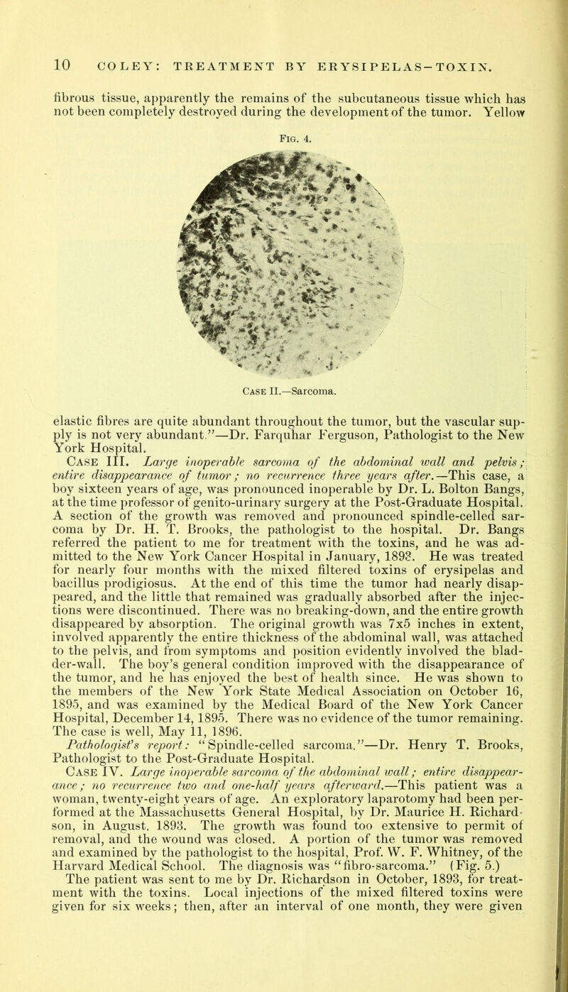 fibrous tissue, apparently the remains of the subcutaneous tissue which has not been completely destroyed during the development of the tumor. Yellow Fig. 4. Case II.—Sarcoma. elastic fibres are quite abundant throughout the tumor, but the vascular sup- ply is not very abundant.”—Dr. Farquhar Ferguson, Pathologist to the New York Hospital. Case III. Large inoperable sarcoma of the abdominal wall and pelvis; entire disappearance of tumor; no recurrence three years after.—This case, a boy sixteen years of age, was pronounced inoperable by Dr. L. Bolton Bangs, at the time professor of genito-urinary surgery at the Post-Graduate Hospital. A section of the growth was removed and pronounced spindle-celled sar- coma by Dr. H. T. Brooks, the pathologist to the hospital. Dr. Bangs referred the patient to me for treatment with the toxins, and he was ad- mitted to the New York Cancer Hospital in January, 1898. He was treated for nearly four months with the mixed filtered toxins of erysipelas and bacillus prodigiosus. At the end of this time the tumor had nearly disap- peared, and the little that remained was gradually absorbed after the injec- tions were discontinued. There was no breaking-down, and the entire growth disappeared by absorption. The original growth was 7x5 inches in extent, involved apparently the entire thickness of the abdominal wall, was attached to the pelvis, and from symptoms and position evidently involved the blad- der-wall. The boy’s general condition improved with the disappearance of the tumor, and he has enjoyed the best of health since. He was shown to the members of the New York State Medical Association on October 16, 1895, and was examined by the Medical Board of the New York Cancer Hospital, December 14,1895. There was no evidence of the tumor remaining. The case is well. May 11, 1896. Pathologist's report: “Spindle-celled sarcoma.”—Dr. Henry T. Brooks, Pathologist to the Post-Graduate Hospital. Case IV. Large inoperable sarcoma of the abdominal wall; entire disappear- ance ; no recurrence two and one-half years afterward.—This patient was a woman, twenty-eight years of age. An exploratory laparotomy had been per- formed at the Massachusetts General Hospital, by Dr. Maurice H. Richard- son, in August. 1893. The growth was found too extensive to permit of removal, and the wound was closed. A portion of the tumor was removed and examined by the pathologist to the hospital. Prof. W. F. Whitney, of the Harvard Medical School. The diagnosis was “fibro-sarcoma.” (Fig. 5.) The patient was sent to me by Dr. Richardson in October, 1893, for treat- ment with the toxins. Local injections of the mixed filtered toxins were given for six weeks; then, after an interval of one month, they were given