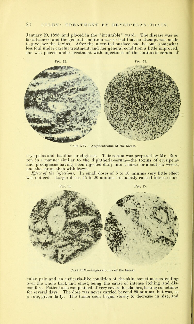 Case XIV.—Angiosarcoma of the breast. erysipelas and bacillus prodigiosus. This serum was prepared by Mr. Bux- ton in a manner similar to the diphtheria-serum—the toxins of erysipelas and prodigiosus having been injected daily into a horse for about six weeks, and the serum then withdrawn. Effect of the injections. In small doses of 5 to 10 minims very little effect was noticed. Larger doses, 15 to 20 minims, frequently caused intense mus- Fig. 14. Fn;. 15. Case XIV.—Angiosarcoma of the breast. cular pain and an urticaria-like condition of the skin, sometimes extending over the whole back and chest, being the cause of intense itching and dis- comfort. Patient also complained of very severe headaches, lasting sometimes for several days. The dose was never carried beyond 20 minims, but was, as a rule, given daily. The tumor soon began slowly to decrease in size, and January 20, 1895, and placed in the “incurable” ward. The disease was so far advanced and the general condition was so bad that no attempt was made to give her the toxins. After the ulcerated surface had become somewhat less foul under careful treatment, and her general condition a little improved, she was placed under treatment with injections of the antitoxin-serum of Fig. 12. Fig. 13.