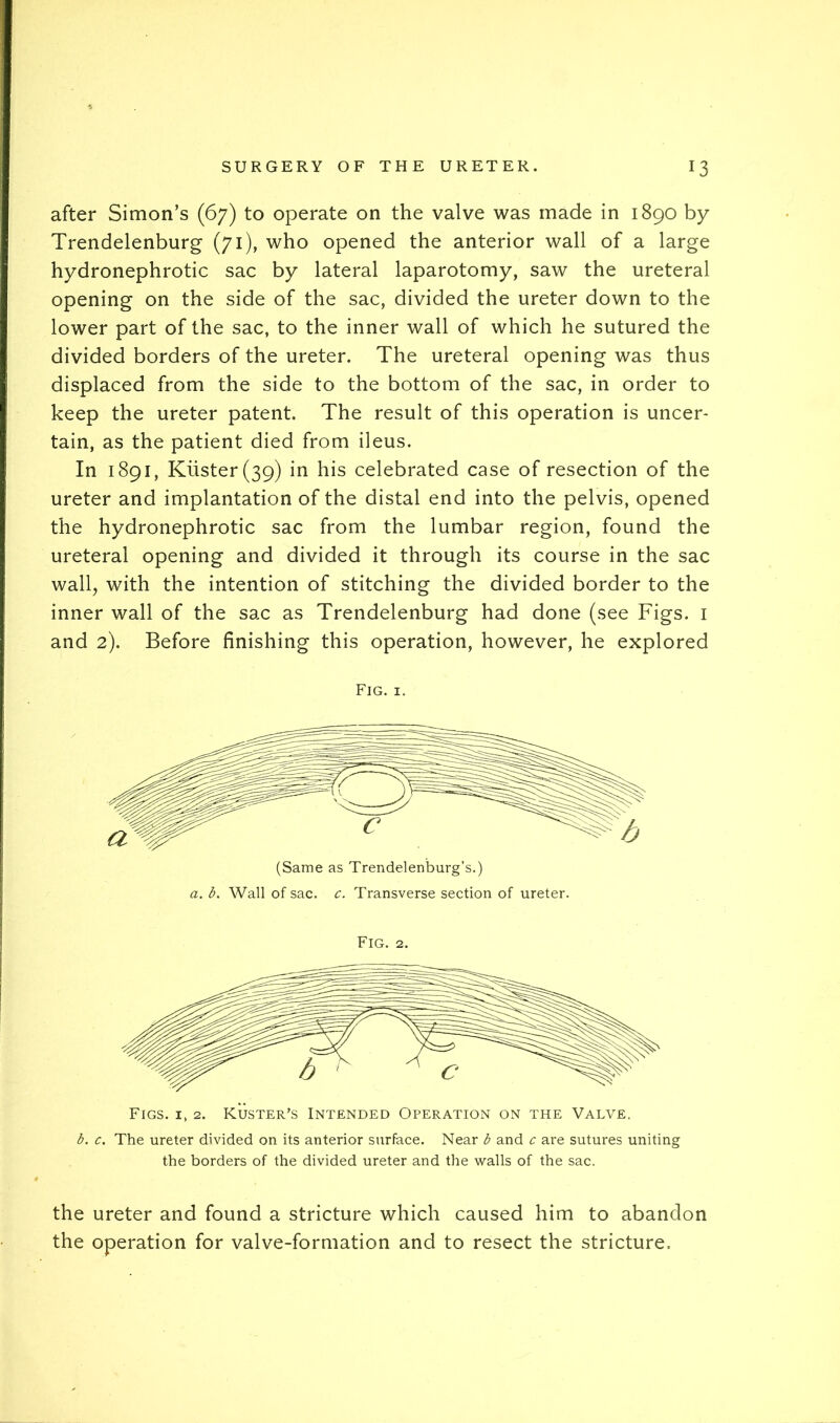 after Simon’s (67) to operate on the valve was made in 1890 by Trendelenburg (71), who opened the anterior wall of a large hydronephrotic sac by lateral laparotomy, saw the ureteral opening on the side of the sac, divided the ureter down to the lower part of the sac, to the inner wall of which he sutured the divided borders of the ureter. The ureteral opening was thus displaced from the side to the bottom of the sac, in order to keep the ureter patent. The result of this operation is uncer- tain, as the patient died from ileus. In 1891, Kiister(39) in his celebrated case of resection of the ureter and implantation of the distal end into the pelvis, opened the hydronephrotic sac from the lumbar region, found the ureteral opening and divided it through its course in the sac wall, with the intention of stitching the divided border to the inner wall of the sac as Trendelenburg had done (see Figs, i and 2). Before finishing this operation, however, he explored Fig. I. Fig. 2. Figs, i, 2. Kuster’s Intended Operation on the Valve. b. c. The ureter divided on its anterior surface. Near b and c are sutures uniting the borders of the divided ureter and the walls of the sac. the ureter and found a stricture which caused him to abandon the operation for valve-formation and to resect the stricture.