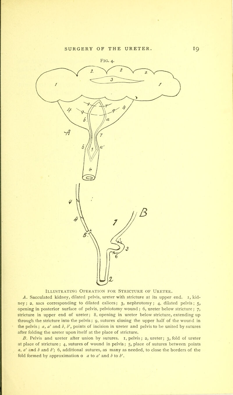 Fig. 4. Illustrating Operation for Stricture of Ureter. A. Sacculated kidney, dilated pelvis, ureter with stricture at its upper end. i, kid- ney,- 2, sacs corresponding to dilated calices; 3, nephrotomy; 4, dilated pelvis; 5, opening in posterior surface of pelvis, pelviotomy wound; 6, ureter below stricture; 7, stricture in upper end of ureter; 8, opening in ureter below stricture, extending up through the stricture into the pelvis; 9, sutures closing the upper half of the wound in the pelvis ; a, a' and b, b', points of incision in ureter and pelvis to be united by sutures after folding the ureter upon itself at the place of stricture. B. Pelvis and ureter after union by sutures, i, pelvis; 2, ureter; 3, fold of ureter at place of stricture ; 4, sutures of wound in pelvis; 5, place of sutures between points a, a' and b and b'] 6, additional sutures, as many as needed, to close the borders of the fold formed by approximation o a io a' and b to b'.