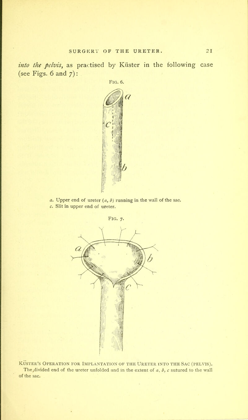 into the pelvis^ as practised by Kiister in the following case (see Figs. 6 and 7): Fig. 6. a. Upper end of ureter {a, b) running in the wall of the sac. c. Slit in upper end of ureter. Fig. 7. Kuster’s Operation for Implantation of the Ureter into the Sac (pelvis). The^divided end of the ureter unfolded and in the extent of a, b, c sutured to the wall of the sac.