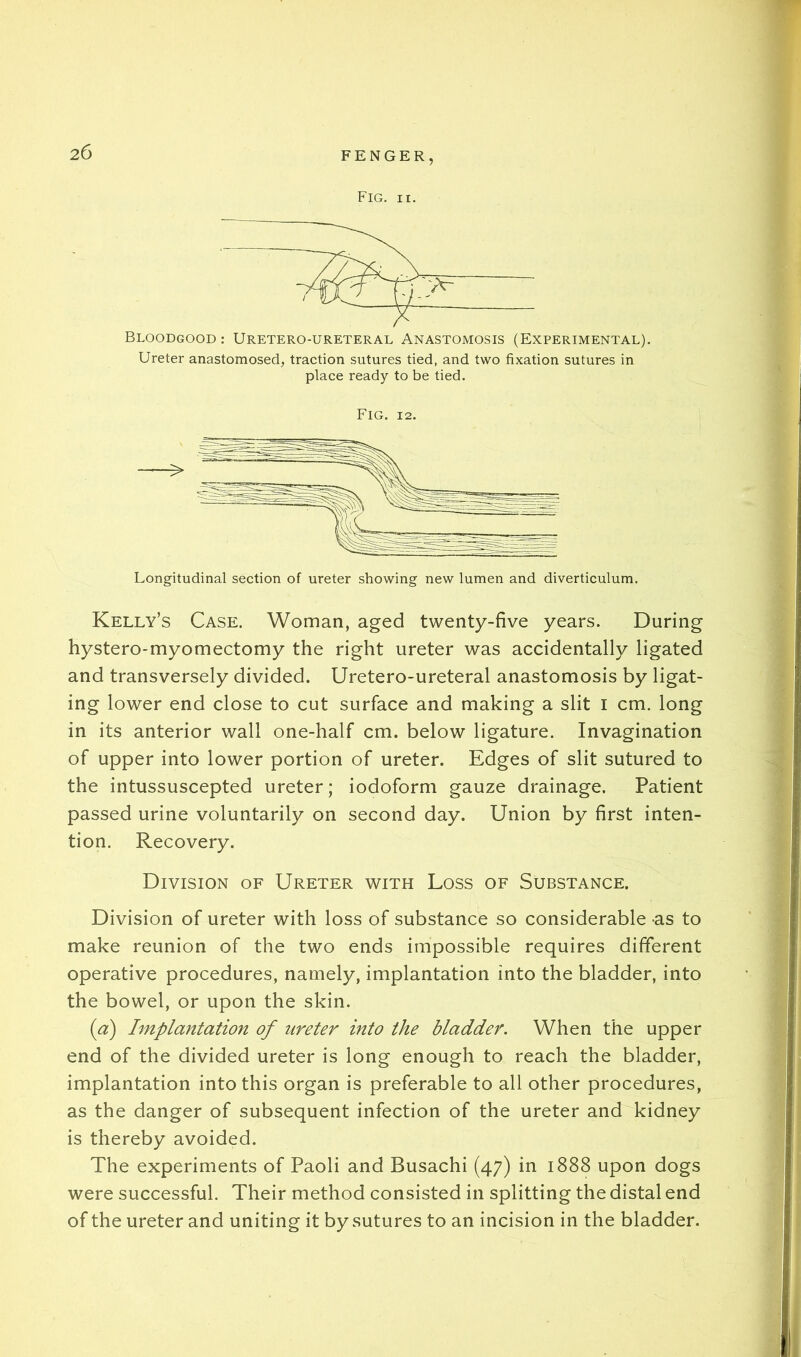 Fig. II. Bloodgood: Uretero-ureteral Anastomosis (Experimental), Ureter anastomosed, traction sutures tied, and two fixation sutures in place ready to be tied. Fig. 12. Longitudinal section of ureter showing new lumen and diverticulum. Kelly’s Case. Woman, aged twenty-five years. During hystero-myomectomy the right ureter was accidentally ligated and transversely divided. Uretero-ureteral anastomosis by ligat- ing lower end close to cut surface and making a slit i cm. long in its anterior wall one-half cm. below ligature. Invagination of upper into lower portion of ureter. Edges of slit sutured to the intussuscepted ureter; iodoform gauze drainage. Patient passed urine voluntarily on second day. Union by first inten- tion. Recovery. Division of Ureter with Loss of Substance. Division of ureter with loss of substance so considerable as to make reunion of the two ends impossible requires different operative procedures, namely, implantation into the bladder, into the bowel, or upon the skin. (a) Implantation of ureter into the bladder. When the upper end of the divided ureter is long enough to reach the bladder, implantation into this organ is preferable to all other procedures, as the danger of subsequent infection of the ureter and kidney is thereby avoided. The experiments of Paoli and Busachi (47) in 1888 upon dogs were successful. Their method consisted in splitting the distal end of the ureter and uniting it by sutures to an incision in the bladder.