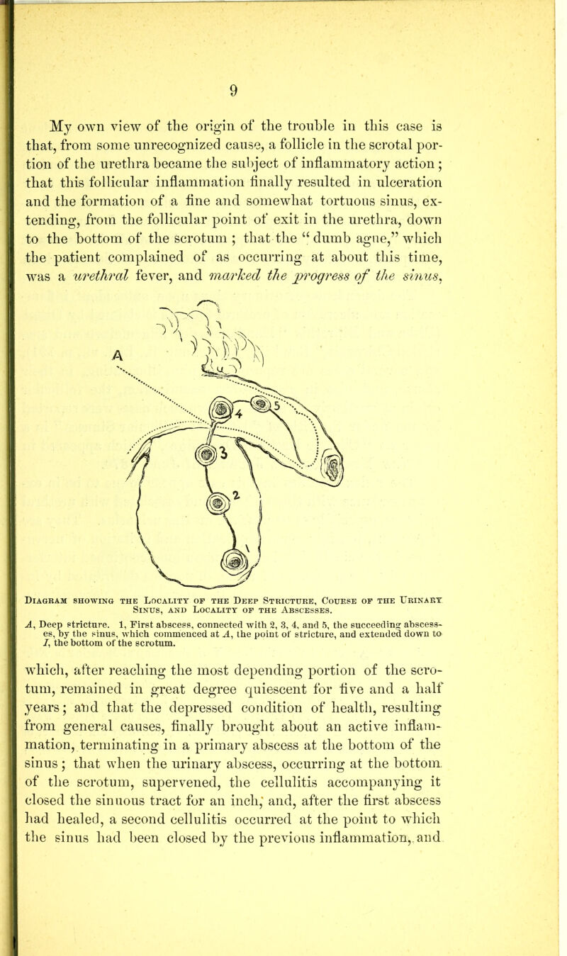 My own view of the origin of the trouble in this case is that, from some unrecognized cause, a follicle in the scrotal por- tion of the urethra became the subject of inflammatory action ; that this follicular inflammation finally resulted in ulceration and the formation of a fine and somewhat tortuous sinus, ex- tending, from the follicular point of exit in the urethra, down to the bottom of the scrotum ; that the dumb ague,” which the patient complained of as occurring at about this time, was a urethral fever, and marked the progress of the sinus^ Diagram showing the Locality of the Deep Stricture, Course of the Urinary Sinus, and Locality of the Abscesses. A, Deep stricture. 1, First abscess, connected with 2, 3, 4, and 5, the succeeding abscess* es, by the sinus, which commenced at J., the point of stricture, and extended down to /, the bottom of the scrotum. whicli, after reaching the most depending portion of the scro- tum, remained in great degree quiescent for five and a half years; and that the depressed condition of health, resulting from general causes, finally brought about an active inflam- mation, terminating in a primary abscess at the bottom of the sinus; that when the urinary abscess, occurring at the bottom, of the scrotum, supervened, the cellulitis accompanying it closed the sinuous tract for an inch; and, after the first abscess had healed, a second cellulitis occurred at the point to which the sinus had been closed by the previous inflammation,, and