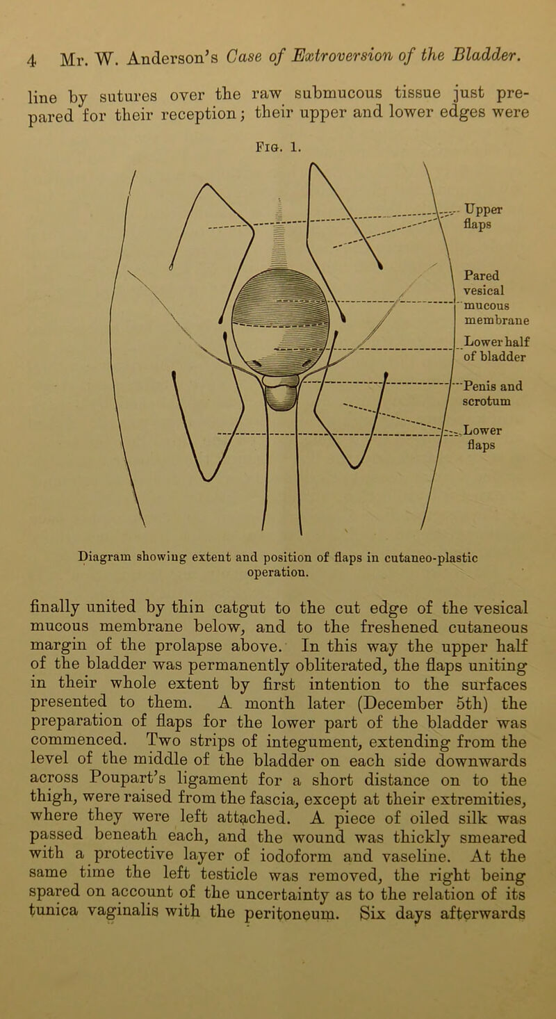 line by sutures over the raw submucous tissue just pre- pared for their reception; their upper and lower edges were Fig. 1. Diagram showing extent and position of flaps in cutaneo-plastic operation. finally united by thin catgut to the cut edge of the vesical mucous membrane below, and to the freshened cutaneous margin of the prolapse above. In this way the upper half of the bladder was permanently obliterated, the flaps uniting in their whole extent by first intention to the surfaces presented to them. A month later (December 5tli) the preparation of flaps for the lower part of the bladder was commenced. Two strips of integument, extending from the level of the middle of the bladder on each side downwards across Poupart’s ligament for a short distance on to the thigh, were raised from the fascia, except at their extremities, where they were left attached. A piece of oiled silk was passed beneath each, and the wound was thickly smeared with a protective layer of iodoform and vaseline. At the same time the left testicle was removed, the right being spared on account of the uncertainty as to the relation of its tunica vaginalis with the peritoneum. Six days afterwards