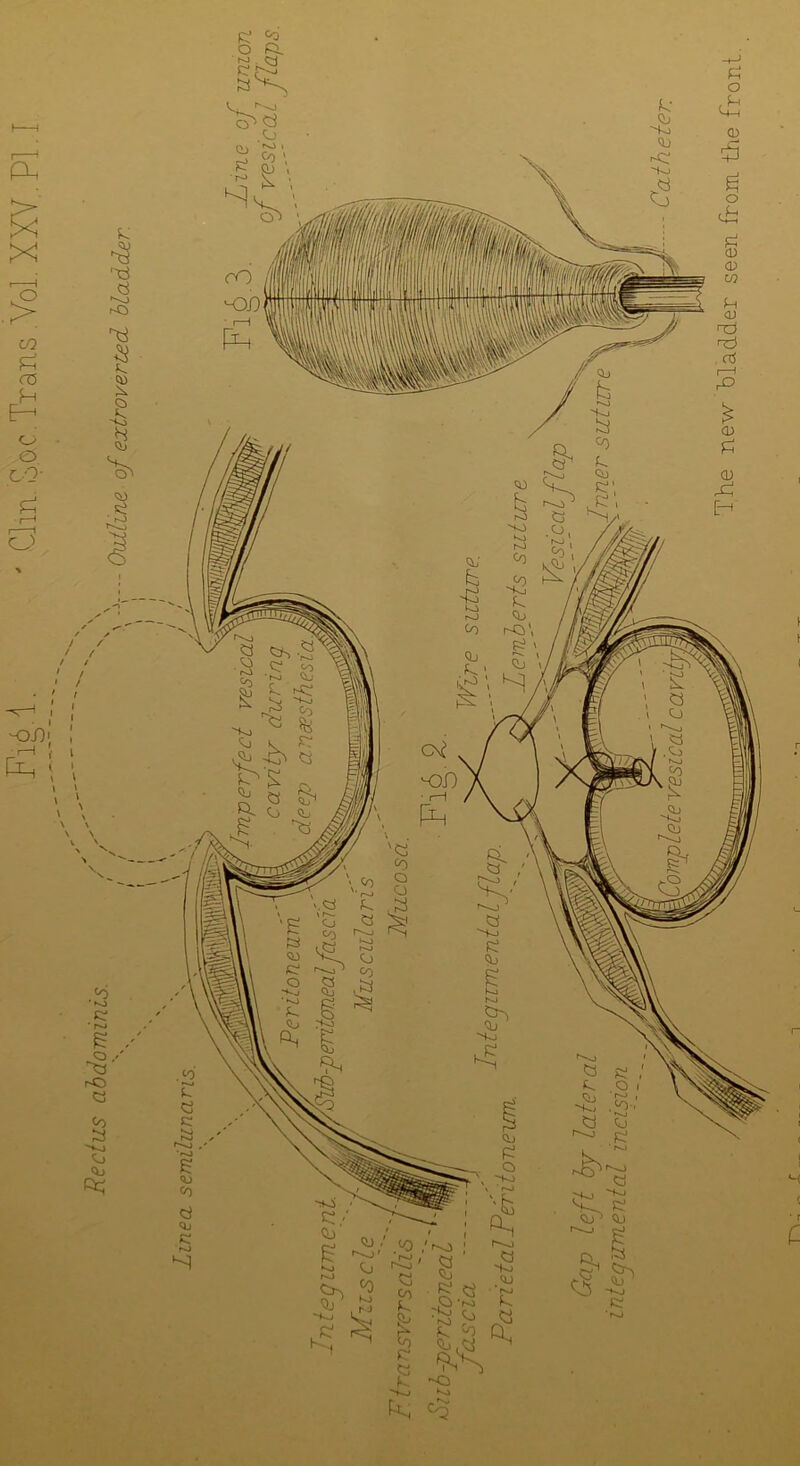 £ £ O PX r-J . Q SN i 1 Ph <73 P «3 P E—1 © co'- P i—( o / s J f t / / / ' / ' / Ha/)' . ,<o £ p§' r-O CO a ~vo Pj oq Fp \ t i i M ( c The new bladder seen from the front.