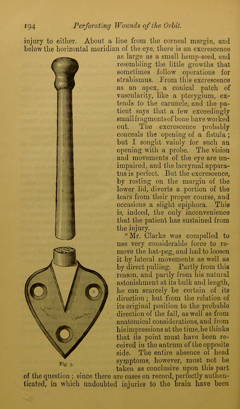 injury to either. About a line from the corneal margin, and below the horizontal meridian of the eye, there is an excrescence as large as a small hemp-seed, and resembling the little growths that sometimes follow operations for strabismus. From this excrescence as an apex, a conical patch of vascularity, like a pterygium, ex- tends to the caruncle, and the pa- tient says that a few exceedingly small fragments of bone have worked out. The excrescence probably conceals the opening of a fistula ; but I sought vainly for such an opening with a probe. The vision and movements of the eye are un- impaired, and the lacrymal appara- tus is perfect. But the excrescence, by resting on the margin of the lowTer lid, diverts a portion of the tears from their proper course, and occasions a slight epiphora. This is, indeed, the only inconvenience that the patient has sustained from the injury. “Mr. Clarke was compelled to use very considerable force to re- move the hat-peg, and had to loosen it by lateral movements as well as by direct pulling. Partly from this reason, and partly from his natural astonishment at its bulk and length, he can scarcely be certain of its direction ; but from the relation of its original position to the probable direction of the fall, as well as from anatomical considerations, and from his impressions at the time, he thinks that its point must have been re- ceived in the antrum of the opposite side. The entire absence of head symptoms, however, must not be taken as conclusive upon this part of the question ; since there are cases on record, perfectly authen- ticated, in which undoubted injuries to the brain have been Fig. 3-