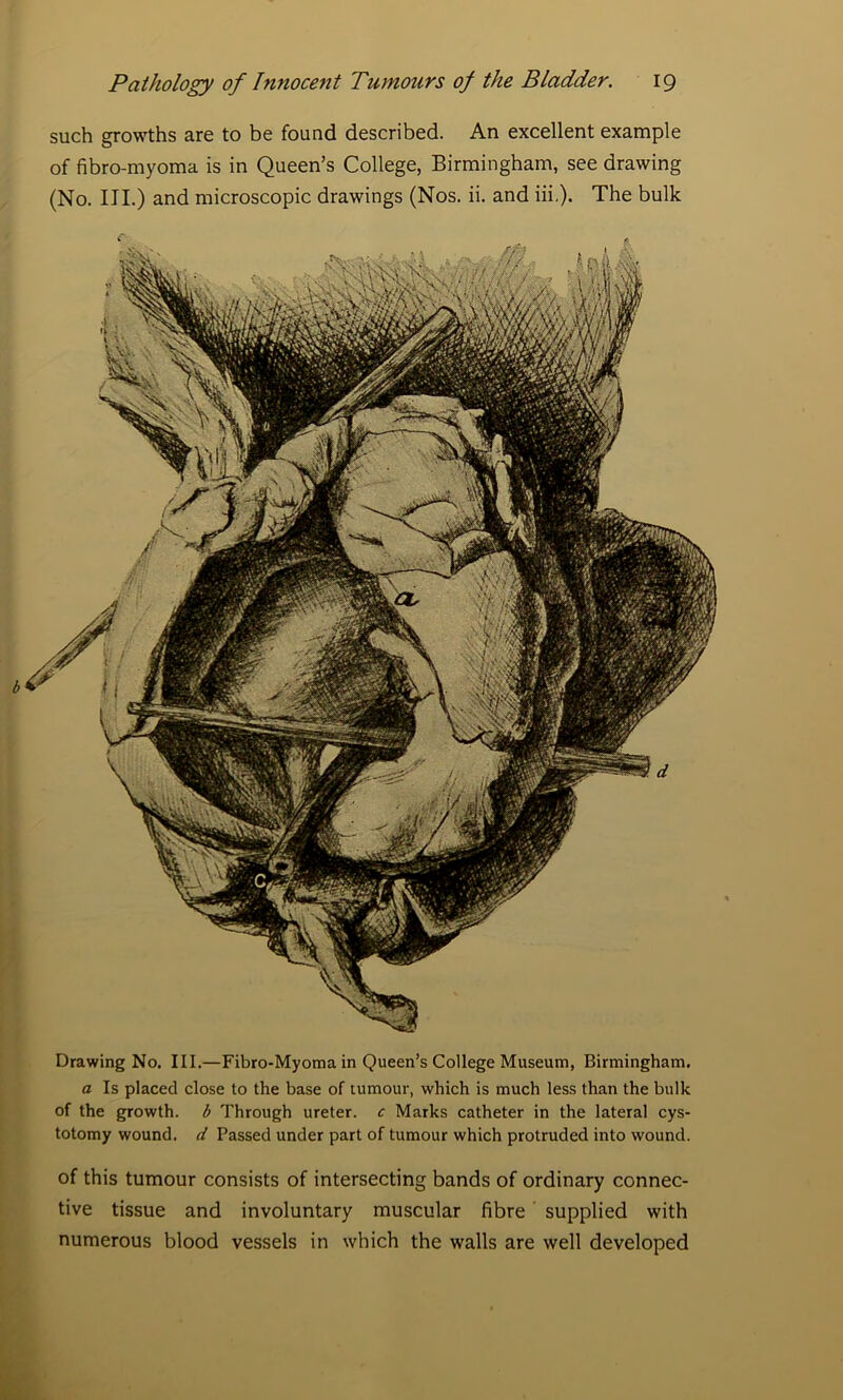 such growths are to be found described. An excellent example of fibro-myoma is in Queen’s College, Birmingham, see drawing (No. III.) and microscopic drawings (Nos. ii. and iii,). The bulk Drawing No. III.—Fibro-Myoma in Queen’s College Museum, Birmingham. a Is placed close to the base of tumour, which is much less than the bulk of the growth, b Through ureter, c Marks catheter in the lateral cys- totomy wound, d Passed under part of tumour which protruded into wound. of this tumour consists of intersecting bands of ordinary connec- tive tissue and involuntary muscular fibre supplied with numerous blood vessels in which the walls are well developed