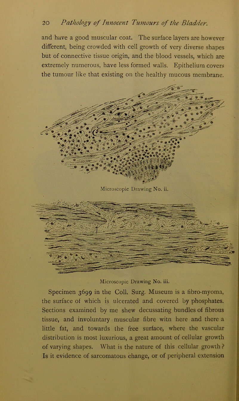 and have a good muscular coat. The surface layers are however different, being crowded with cell growth of very diverse shapes but of connective tissue origin, and the blood vessels, which are extremely numerous, have less formed walls. Epithelium covers the tumour like that existing on the healthy mucous membrane. Microscopic Drawing No. ii. Microscopic Drawing No. iii. Specimen 3699 in the Coll. Surg. Museum is a fibro-myoma, the surface of which is ulcerated and covered by phosphates. Sections examined by me shew decussating bundles of fibrous tissue, and involuntary muscular fibre witn here and there a little fat, and towards the free surface, where the vascular distribution is most luxurious, a great amount of cellular growth of varying shapes. What is the nature of this cellular growth ? Is it evidence of sarcomatous change, or of peripheral extension