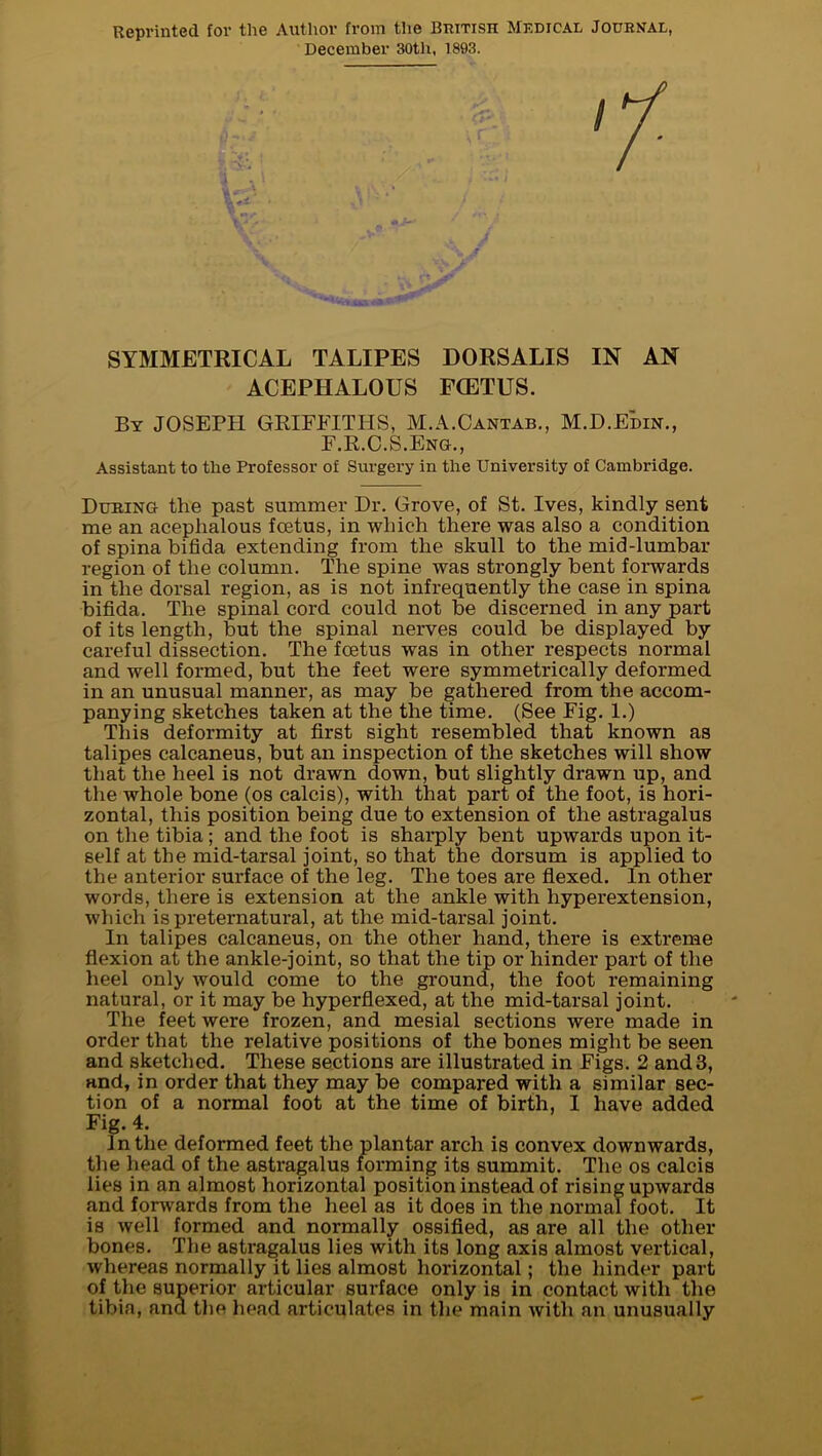 December 30tli, 1893. SYMMETRICAL TALIPES DORSALIS IN AN ACEPHALOUS FCETUS. By JOSEPH GRIFFITHS, M.A.Cantab., M.D.Edin., F.R.C.S.Eng., Assistant to the Professor of Surgery in the University of Cambridge. During the past summer Dr. Grove, of St. Ives, kindly sent me an acephalous foetus, in which there was also a condition of spina bifida extending from the skull to the mid-lumbar region of the column. The spine was strongly bent forwards in the dorsal region, as is not infrequently the case in spina bifida. The spinal cord could not be discerned in any part of its length, but the spinal nerves could be displayed by careful dissection. The foetus was in other respects normal and well formed, but the feet were symmetrically deformed in an unusual manner, as may be gathered from the accom- panying sketches taken at the the time. (See Fig. 1.) This deformity at first sight resembled that known as talipes calcaneus, but an inspection of the sketches will show that the heel is not drawn down, but slightly drawn up, and the whole bone (os calcis), with that part of the foot, is hori- zontal, this position being due to extension of the astragalus on the tibia; and the foot is sharply bent upwards upon it- self at the mid-tarsal joint, so that the dorsum is applied to the anterior surface of the leg. The toes are flexed. In other words, there is extension at the ankle with hyperextension, which is preternatural, at the mid-tarsal joint. In talipes calcaneus, on the other hand, there is extreme flexion at the ankle-joint, so that the tip or hinder part of the heel only would come to the ground, the foot remaining natural, or it may be hyperflexed, at the mid-tarsal joint. The feet were frozen, and mesial sections were made in order that the relative positions of the bones might be seen and sketched. These sections are illustrated in Figs. 2 and3, and, in order that they may be compared with a similar sec- tion of a normal foot at the time of birth, 1 have added Fig. 4. In the deformed feet the plantar arch is convex downwards, the head of the astragalus forming its summit. The os calcis lies in an almost horizontal position instead of rising upwards and forwards from the heel as it does in the normal foot. It is well formed and normally ossified, as are all the other bones. The astragalus lies with its long axis almost vertical, whereas normally it lies almost horizontal; the hinder part of the superior articular surface only is in contact with the tibia, and the head articulates in the main ivith an unusually
