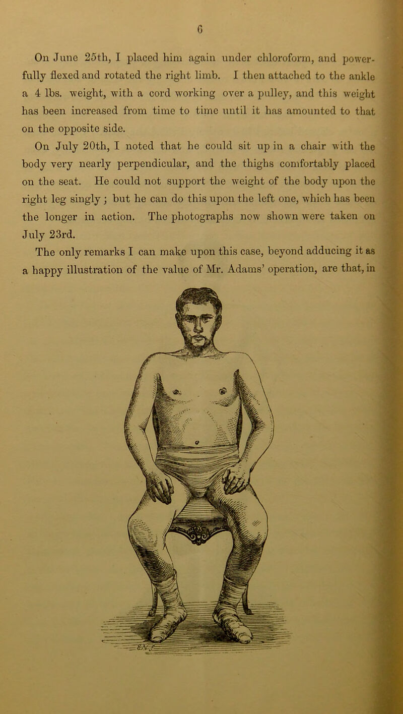 G On June 25th, I placed him again under chloroform, and power- fully flexed and rotated the right limb. I then attached to the ankle a 4 lbs. weight, with a cord working over a pulley, and this weight has been increased from time to time until it has amounted to that on the opposite side. On July 20th, I noted that he could sit up in a chair with the body very nearly perpendicular, and the thighs comfortably placed on the seat. He could not support the weight of the body upon the right leg singly ; but he can do this upon the left one, which has been the longer in action. The photographs now shown were taken on July 23rd. The only remarks I can make upon this case, beyond adducing it as a happy illustration of the value of Mr. Adams’ operation, are that, in