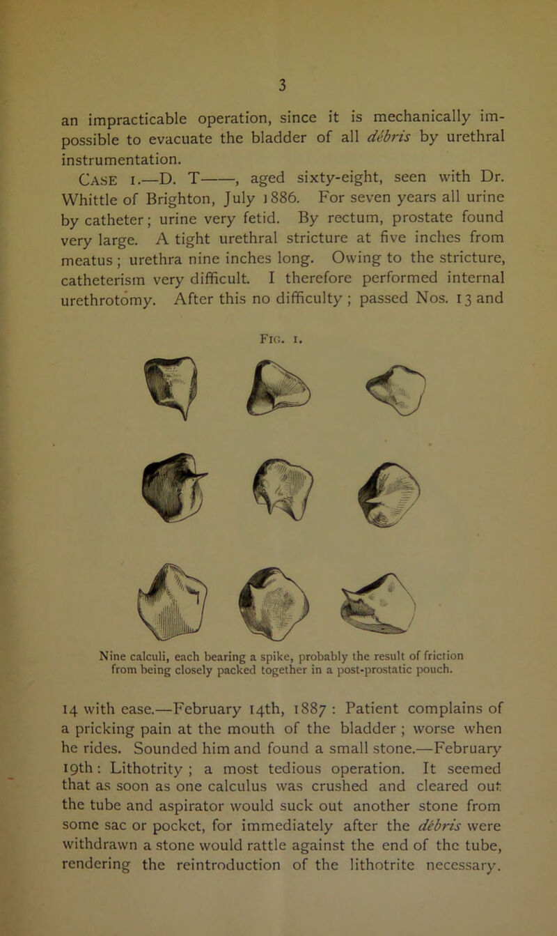 an impracticable operation, since it is mechanically im- possible to evacuate the bladder of all debris by urethral instrumentation. Case i.—D. T , aged sixty-eight, seen with Dr. Whittle of Brighton, July 1886. For seven years all urine by catheter; urine very fetid. By rectum, prostate found very large. A tight urethral stricture at five inches from meatus; urethra nine inches long. Owing to the stricture, catheterism very difficult. I therefore performed internal urethrotomy. After this no difficulty ; passed Nos. 13 and Nine calculi, each bearing a spike, probably the result of friction from being closely packed together in a post-prostatic pouch. 14 with ease.—February 14th, 1887: Patient complains of a pricking pain at the mouth of the bladder ; worse when he rides. Sounded him and found a small stone.—February 19th : Lithotrity ; a most tedious operation. It seemed that as soon as one calculus was crushed and cleared out the tube and aspirator would suck out another stone from some sac or pocket, for immediately after the debris were withdrawn a stone would rattle against the end of the tube, rendering the reintroduction of the lithotrite necessary. Fig. 1.