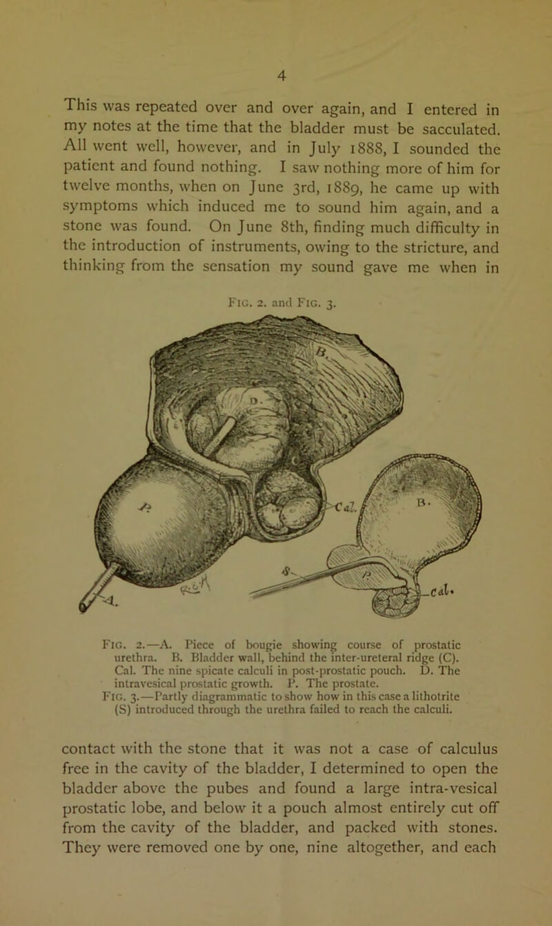 This was repeated over and over again, and I entered in my notes at the time that the bladder must be sacculated. All went well, however, and in July 1888, I sounded the patient and found nothing. I saw nothing more of him for twelve months, when on June 3rd, 1889, he came up with symptoms which induced me to sound him again, and a stone was found. On June 8th, finding much difficulty in the introduction of instruments, owing to the stricture, and thinking from the sensation my sound gave me when in Fig. 2. and Fig. 3. Fig. 2.—A. Piece of bougie showing course of prostatic urethra. B. Bladder wall, behind the inter-ureteral ridge (C). Cal. The nine spicate calculi in post-prostatic pouch. D. The intravesical prostatic growth. P. The prostate. F'ig. 3.—Partly diagrammatic to show how in this case a lithotritc (S) introduced through the urethra failed to reach the calculi. contact with the stone that it was not a case of calculus free in the cavity of the bladder, I determined to open the bladder above the pubes and found a large intra-vesical prostatic lobe, and below it a pouch almost entirely cut off from the cavity of the bladder, and packed with stones. They were removed one by one, nine altogether, and each