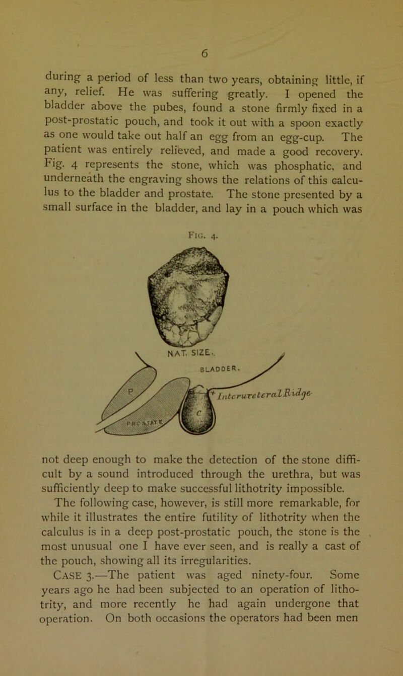 during a period of less than two years, obtaining little, if any, relief. He was suffering greatly. I opened the bladder above the pubes, found a stone firmly fixed in a post-prostatic pouch, and took it out with a spoon exactly as one would take out half an egg from an egg-cup. The patient was entirely relieved, and made a good recovery. Fig. 4 represents the stone, which was phosphatic, and underneath the engraving shows the relations of this calcu- lus to the bladder and prostate. The stone presented by a small surface in the bladder, and lay in a pouch which was Fig. 4. not deep enough to make the detection of the stone diffi- cult by a sound introduced through the urethra, but was sufficiently deep to make successful lithotrity impossible. The following case, however, is still more remarkable, for while it illustrates the entire futility of lithotrity when the calculus is in a deep post-prostatic pouch, the stone is the most unusual one I have ever seen, and is really a cast of the pouch, showing all its irregularities. Case 3.—The patient was aged ninety-four. Some years ago he had been subjected to an operation of litho- trity, and more recently he had again undergone that operation. On both occasions the operators had been men