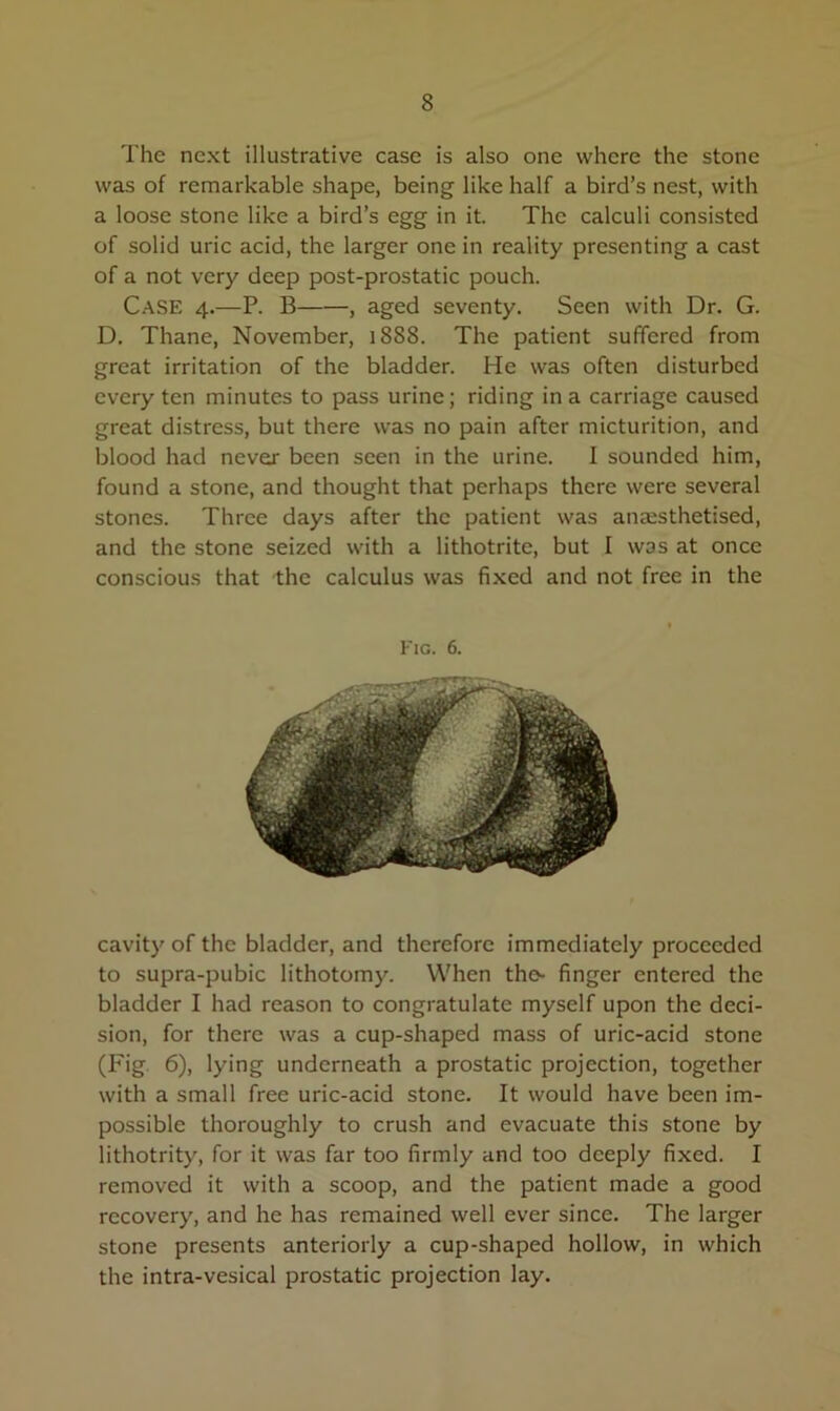 The next illustrative case is also one where the stone was of remarkable shape, being like half a bird’s nest, with a loose stone like a bird’s egg in it. The calculi consisted of solid uric acid, the larger one in reality presenting a cast of a not very deep post-prostatic pouch. Case 4.—P. B , aged seventy. Seen with Dr. G. D. Thane, November, 1888. The patient suffered from great irritation of the bladder. He was often disturbed every ten minutes to pass urine; riding in a carriage caused great distress, but there was no pain after micturition, and blood had never been seen in the urine. I sounded him, found a stone, and thought that perhaps there were several stones. Three days after the patient was anaesthetised, and the stone seized with a lithotrite, but I was at once conscious that the calculus was fixed and not free in the Fig. 6. cavity of the bladder, and therefore immediately proceeded to supra-pubic lithotomy. When the- finger entered the bladder I had reason to congratulate myself upon the deci- sion, for there was a cup-shaped mass of uric-acid stone (Fig 6), lying underneath a prostatic projection, together with a small free uric-acid stone. It would have been im- possible thoroughly to crush and evacuate this stone by lithotrity, for it was far too firmly and too deeply fixed. I removed it with a scoop, and the patient made a good recovery, and he has remained well ever since. The larger stone presents anteriorly a cup-shaped hollow, in which the intra-vesical prostatic projection lay.
