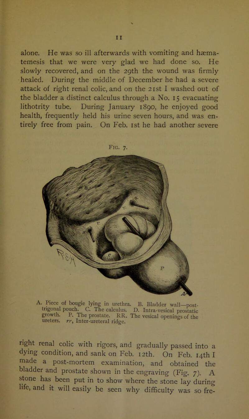 alone. He was so ill afterwards with vomiting and haema- temesis that we were very glad we had done so. He slowly recovered, and on the 29th the wound was firmly healed. During the middle of December he had a severe attack of right renal colic, and on the 21st I washed out of the bladder a distinct calculus through a No. 15 evacuating lithotrity tube. During January 1890, he enjoyed good health, frequently held his urine seven hours, and was en- tirely free from pain. On Feb. 1st he had another severe Fig. 7. A. Piece of bougie lying in urethra. B. Bladder wall—post- trigonal pouch. C. The calculus. D. Intra-vesical prostatic growth. P. The prostate. RR. The vesical openings of the ureters, rr, Inter-ureteral ridge. right renal colic with rigors, and gradually passed into a dying condition, and sank on Feb. 12th. On Feb. 14th I made a post-mortem examination, and obtained the bladder and prostate shown in the engraving (Fig. 7). A stone has been put in to show where the stone lay during life, and it will easily be seen why difficulty was so fre-