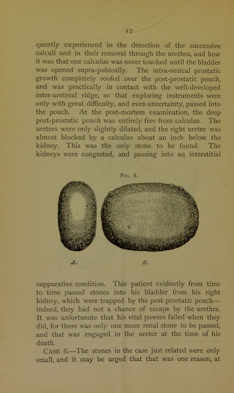 quently experienced in the detection of the successive calculi and in their removal through the urethra, and how it was that one calculus was never touched until the bladder was opened supra-pubically. The intra-vesical prostatic growth completely roofed over the post-prostatic pouch, and was practically in contact with the well-developed inter-ureteral ridge, so that exploring instruments were only with great difficulty, and even uncertainty, passed into the pouch. At the post-mortem examination, the deep post-prostatic pouch was entirely free from calculus. The ureters were only slightly dilated, and the right ureter was almost blocked by a calculus about an inch below the kidney. This was the only stone to be found. The kidneys were congested, and passing into an interstitial Fig. 8. A. B. suppurative condition. This patient evidently from time to time passed stones into his bladder from his right kidney, which were trapped by the post-prostatic pouch— indeed, they had not a chance of escape by the urethra. It was unfortunate that his vital powers failed when they did, for there was only one more renal stone to be passed, and that was engaged in the ureter at the time of his death. Case 6.—The stones in the case just related were only small, and it may be urged that that was one reason, at