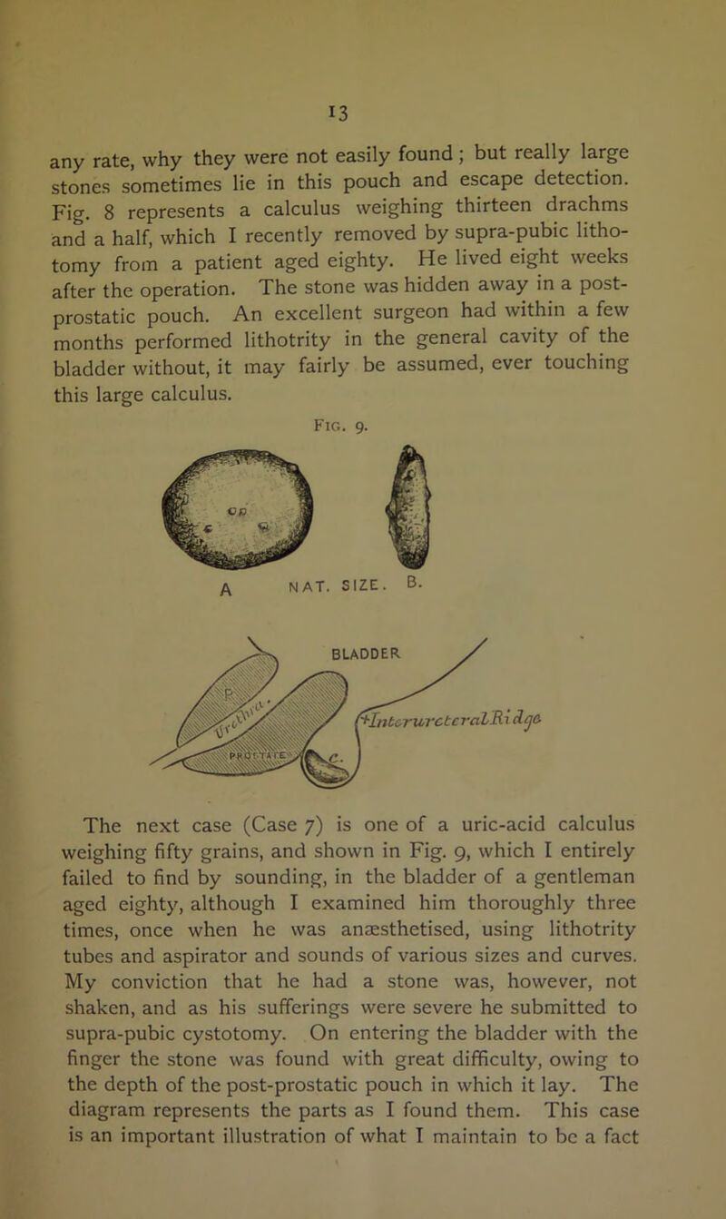 any rate, why they were not easily found; but really large stones sometimes lie in this pouch and escape detection. Fig. 8 represents a calculus weighing thirteen drachms and a half, which I recently removed by supra-pubic litho- tomy from a patient aged eighty. He lived eight weeks after the operation. The stone was hidden away in a post- prostatic pouch. An excellent surgeon had within a few months performed lithotrity in the general cavity of the bladder without, it may fairly be assumed, ever touching this large calculus. Fig. 9. A NAT. SIZE. B. The next case (Case 7) is one of a uric-acid calculus weighing fifty grains, and shown in Fig. 9, which I entirely failed to find by sounding, in the bladder of a gentleman aged eighty, although I examined him thoroughly three times, once when he was anaesthetised, using lithotrity tubes and aspirator and sounds of various sizes and curves. My conviction that he had a stone was, however, not shaken, and as his sufferings were severe he submitted to supra-pubic cystotomy. On entering the bladder with the finger the stone was found with great difficulty, owing to the depth of the post-prostatic pouch in which it lay. The diagram represents the parts as I found them. This case is an important illustration of what I maintain to be a fact