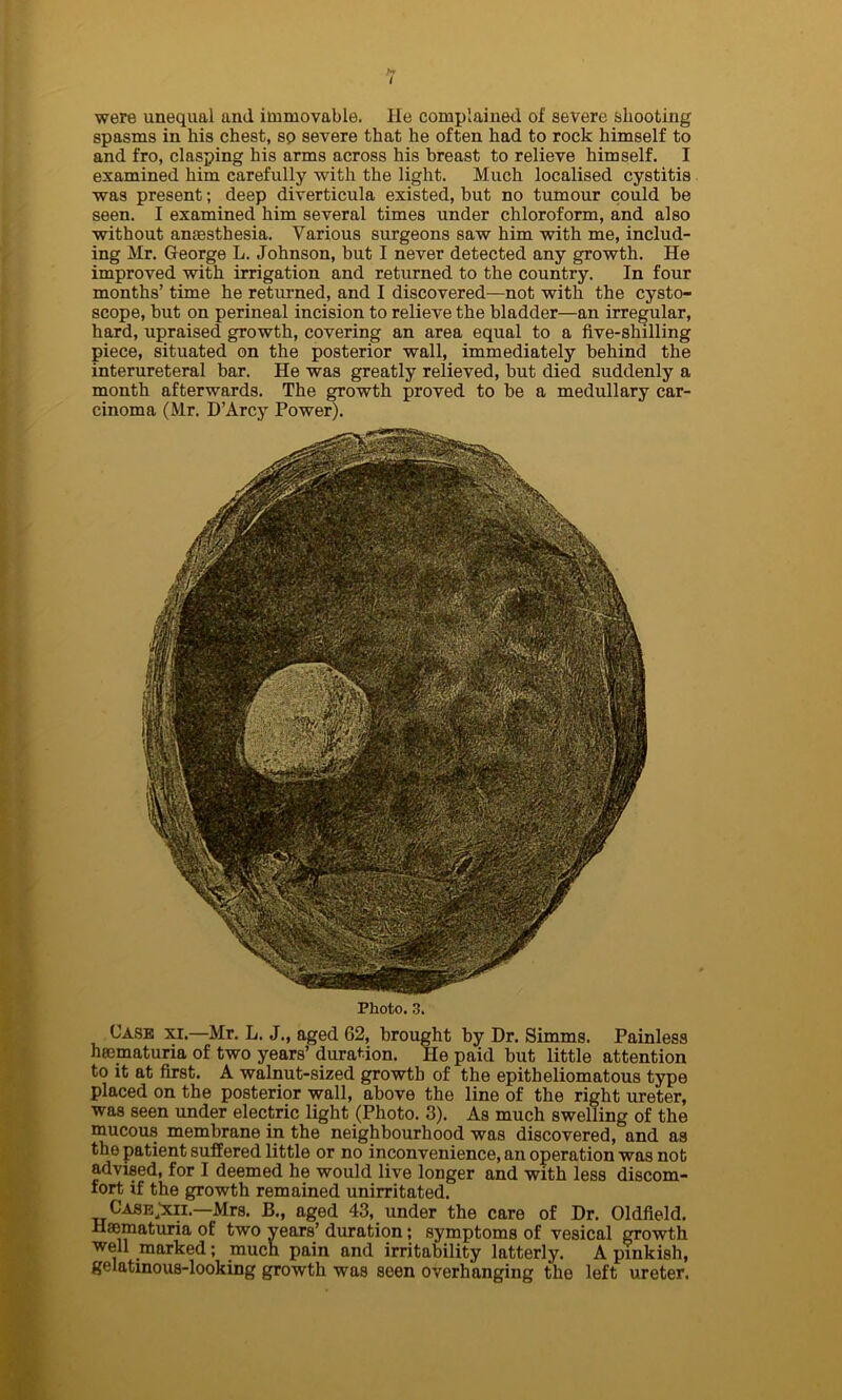 were unequal and immovable. He complained of severe shooting spasms in his chest, sp severe that he often had to rock himself to and fro, clasping his arms across his breast to relieve himself. I examined him carefully with the light. Much localised cystitis was present; deep diverticula existed, but no tumour could be seen. I examined him several times under chloroform, and also without anaesthesia. Various surgeons saw him with me, includ- ing Mr. George L. Johnson, but I never detected any growth. He improved with irrigation and returned to the country. In four months’ time he returned, and I discovered—not with the cysto- scope, but on perineal incision to relieve the bladder—an irregular, hard, upraised growth, covering an area equal to a five-shilling piece, situated on the posterior wall, immediately behind the interureteral bar. He was greatly relieved, but died suddenly a month afterwards. The growth proved to be a medullary car- cinoma (Mr. D’Arcy Power). Photo. 3. Case xi.—Mr. L. J., aged 62, brought by Dr. Simms. Painless heematuria of two years’ duration. He paid but little attention to it at first. A walnut-sized growth of the epitheliomatous type placed on the posterior wall, above the line of the right ureter, was seen under electric light (Photo. 3). As much swelling of the mucous membrane in the neighbourhood was discovered, and as the patient suffered little or no inconvenience, an operation was not advised, for I deemed he would live longer and with less discom- fort if the growth remained unirritated. Case>ii.—Mrs. B., aged 43, under the care of Dr. Oldfield. Haematuria of two years’ duration; symptoms of vesical growth well marked; much pain and irritability latterly. A pinkish, gelatinous-looking growth was seen overhanging the left ureter.