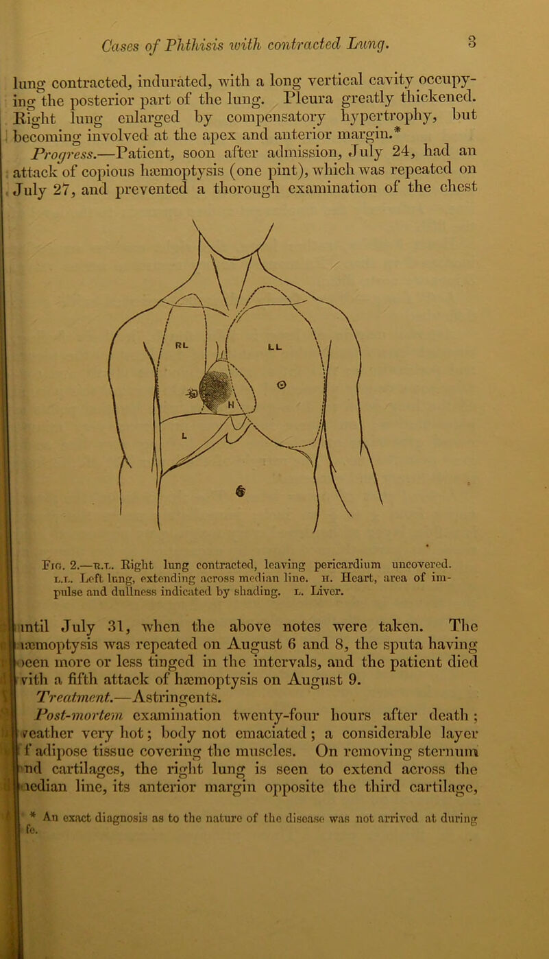 lung contracted, indurated, with a long vertical cavity occupy- ing the posterior part of the lung. Pleura greatly thickened. Right lung enlarged by compensatory hypertrophy, but : becoming involved at the apex and anterior margin.* Progress.—Patient, soon after admission, July 24, had an attack of copious hiemoptysis (one pint), which was repeated on July 27, and prevented a thorough examination of the chest Fig. 2.—ux. Right lung contracted, leaving pericardium uncovered. lx. Left lung, extending across median lino. n. Heart, area of im- pulse and dullness indicated by shading, l. Livor. £ until July 31, when the above notes were taken. The n uemoptysis was repeated on August 6 and 8, the sputa having Hoeen more or less tinged in the intervals, and the patient died \ [I vith a fifth attack of haemoptysis on August 9. Treatment.—Astringents. Post-mortem examination twenty-four hours after death ; I weather very hot; body not emaciated ; a considerable layer f adipose tissue covering the muscles. On removing sternum nd cartilages, the right lung is seen to extend across the i ledian line, its anterior margin opposite the third cartilage, f * An exact diagnosis as to the nature of the disoase was not arrived at during fo.