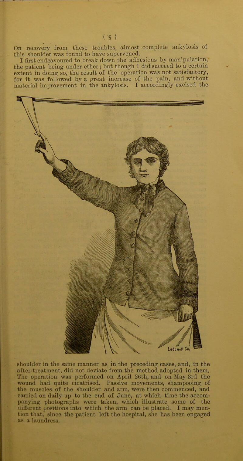 On recovery from these troubles, almost complete ankylosis of this shoulder was found to have supervened. I first endeavoured to break down the adhesions by manipulation, the patient being under ether; but though I did succeed to a certain extent in doing so, the result of the operation was not satisfactory, for it was followed by a great increase of the pain, and without material improvement in the ankylosis. I accordingly excised the v-~—— Slid Lsbonf Co, shoulder in the same manner as in the preceding cases, and, in the after-treatment, did not deviate from the method adopted in them. The operation was performed on April 26th, and on May 3rd the wound had quite cicatrised. Passive movements, shampooing of the muscles of the shoulder and arm, were then commenced, and carried on daily up to the end of June, at which time the accom- panying photographs were taken, which illustrate some of the different positions into which the arm can bo placed. I may men- tion that, since the patient left the hospital, she has been engaged as a laundress.