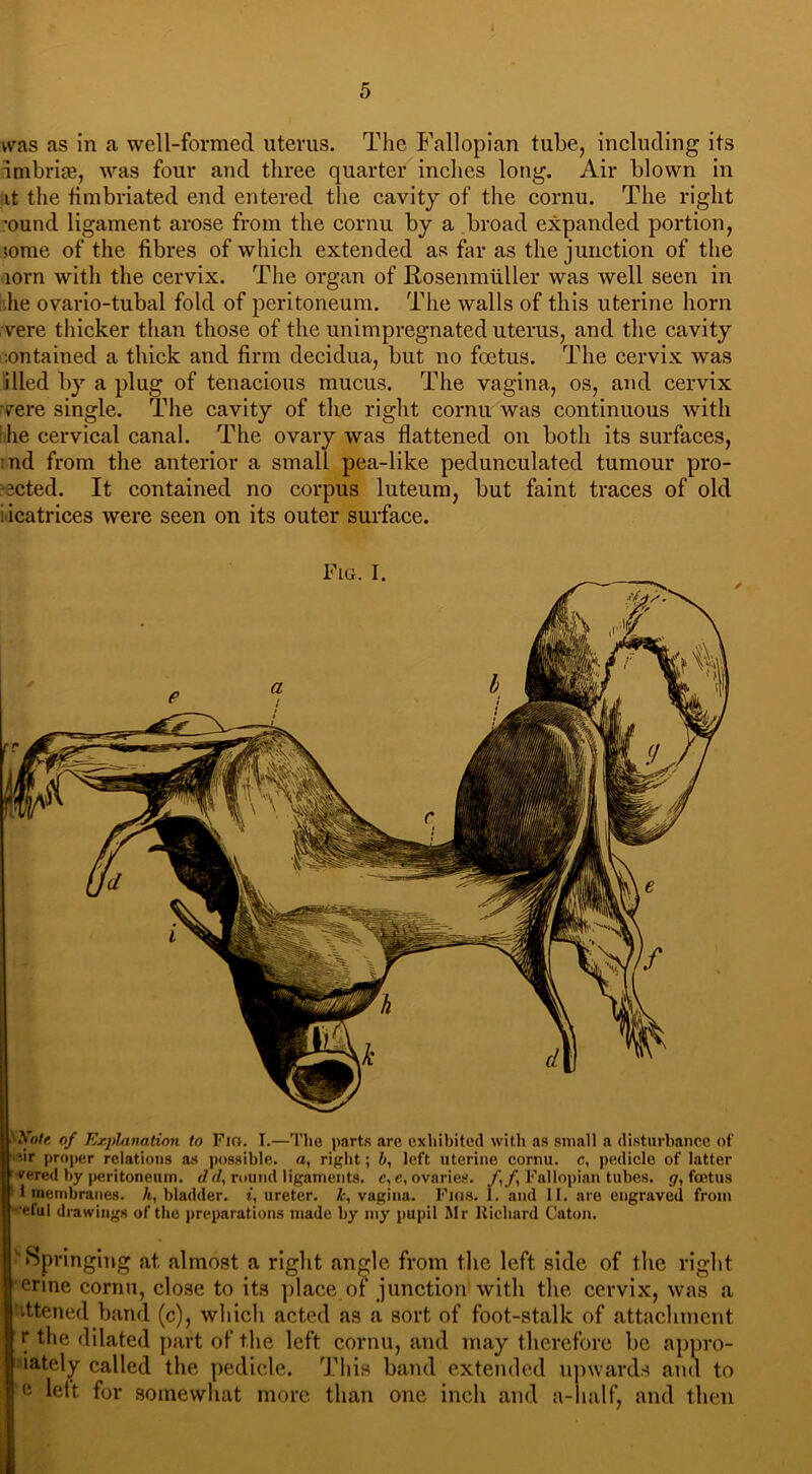 was as in a well-formed uterus. The Fallopian tube, including its imbrue, was four and three quarter inches long. Air blown in it the fimbriated end entered the cavity of the cornu. The right ound ligament arose from the cornu by a broad expanded portion, some of the fibres of which extended as far as the junction of the 10m with the cervix. The organ of Rosenmuller was well seen in lie ovario-tubal fold of peritoneum. The walls of this uterine horn vere thicker than those of the unimpregnated uterus, and the cavity .ontained a thick and firm decidua, but no foetus. The cervix was died by a plug of tenacious mucus. The vagina, os, and cervix were single. The cavity of the right cornu was continuous with he cervical canal. The ovary was flattened on both its surfaces, :nd from the anterior a small pea-like pedunculated tumour pro- moted. It contained no corpus luteum, but faint traces of old i icatrices were seen on its outer surface. Xotc, of Explanation to Fm. I.—The parts are exhibited with as small a disturbance of *-ir proper relations as possible, a, right; b, left uterine cornu, c, pedicle of latter 1 vered by peritoneum, d d, round ligaments, c, e, ovaries. /,/, Fallopian tubes, g, foetus 1 membranes. 7t, bladder, i, ureter, k, vagina. Figs. 1. and II. are engraved from eful drawings of the preparations made by my pupil Mr Richard Caton. ! Springing at almost a right angle from the left side of the right erine cornu, close to its place of junction with the cervix, was a ittened band (c), which acted as a sort of foot-stalk of attachment r the dilated part of the left cornu, and may therefore be appro- iately called the pedicle. This band extended upwards and to e left for somewhat more than one inch and a-half, and then