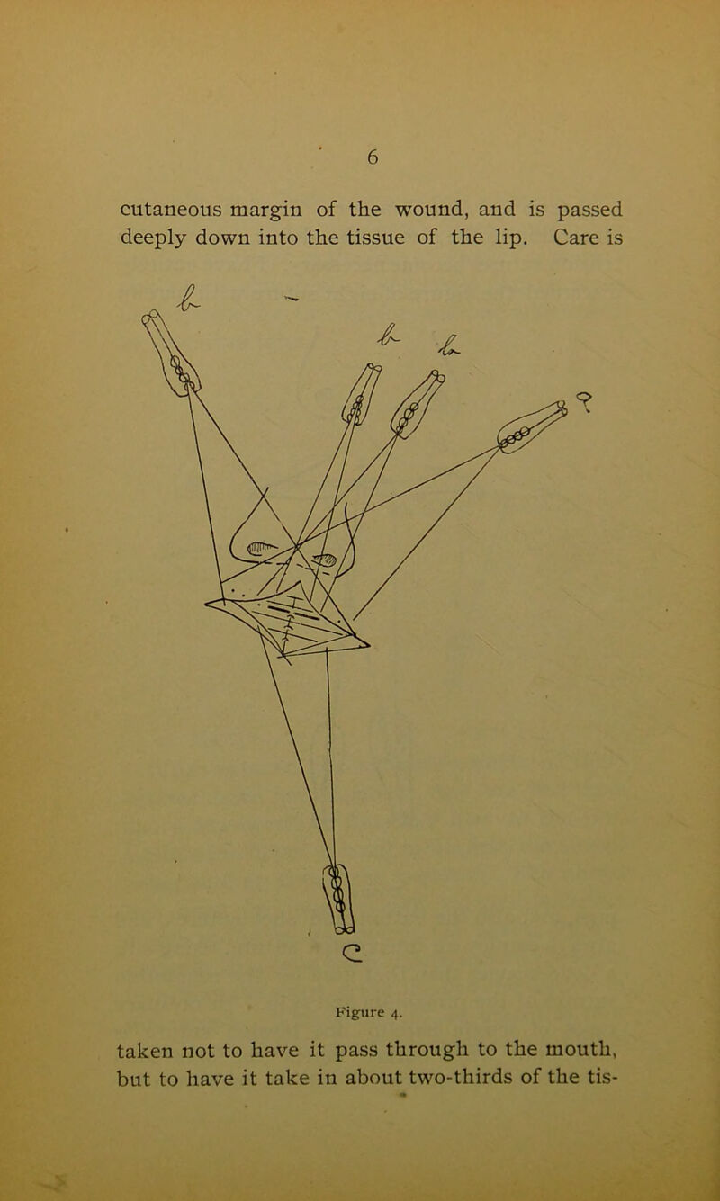 cutaneous margin of the wound, and is passed deeply down into the tissue of the lip. Care is Figure 4. taken not to have it pass through to the mouth, but to have it take in about two-thirds of the tis-