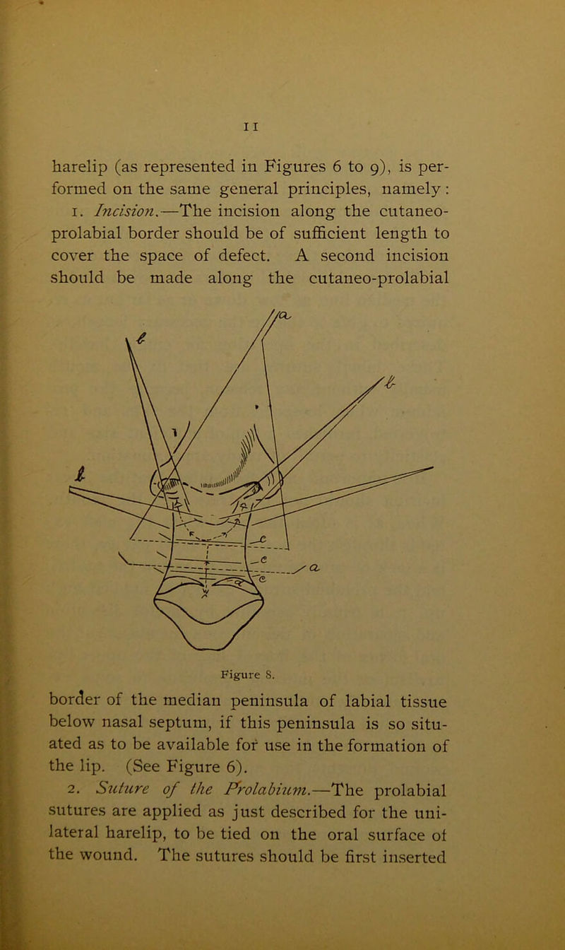 formed on the same general principles, namely : 1. Incision.—The incision along the cutaneo- prolabial border should be of sufficient length to cover the space of defect. A second incision should be made along the cutaneo-prolabial Figure S. border of the median peninsula of labial tissue below nasal septum, if this peninsula is so situ- ated as to be available for use in the formation of the lip. (See Figure 6). 2. Silt are of the Frolabium.—The prolabial sutures are applied as just described for the uni- lateral harelip, to be tied on the oral surface of the wound. The sutures should be first inserted