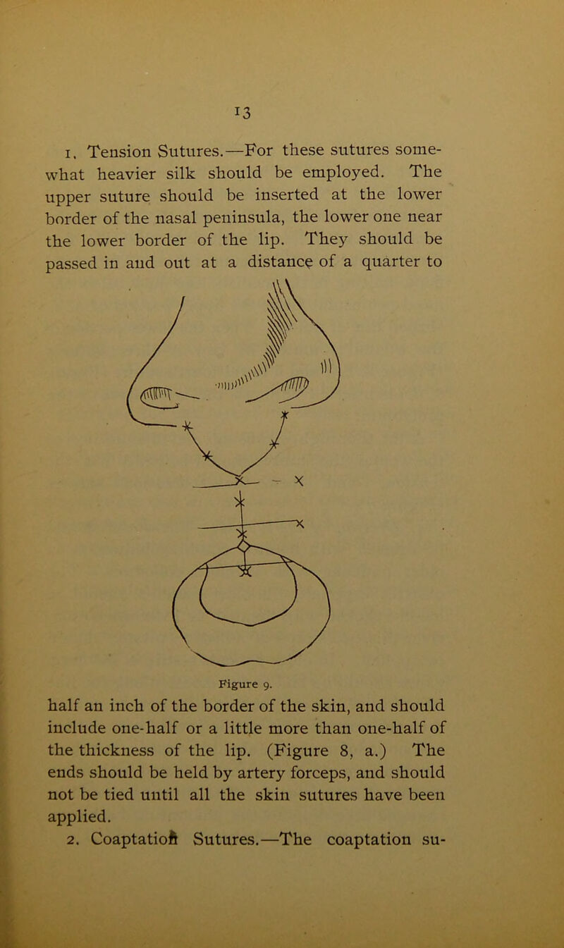 i. Tension Sutures.—For these sutures some- what heavier silk should be employed. The upper suture should be inserted at the lower border of the nasal peninsula, the lower one near the lower border of the lip. They should be passed in and out at a distance of a quarter to Figure 9. half an inch of the border of the skin, and should include one-half or a little more than one-half of the thickness of the lip. (Figure 8, a.) The ends should be held by artery forceps, and should not be tied until all the skin sutures have been applied. 2. Coaptatioft Sutures.—The coaptation su-