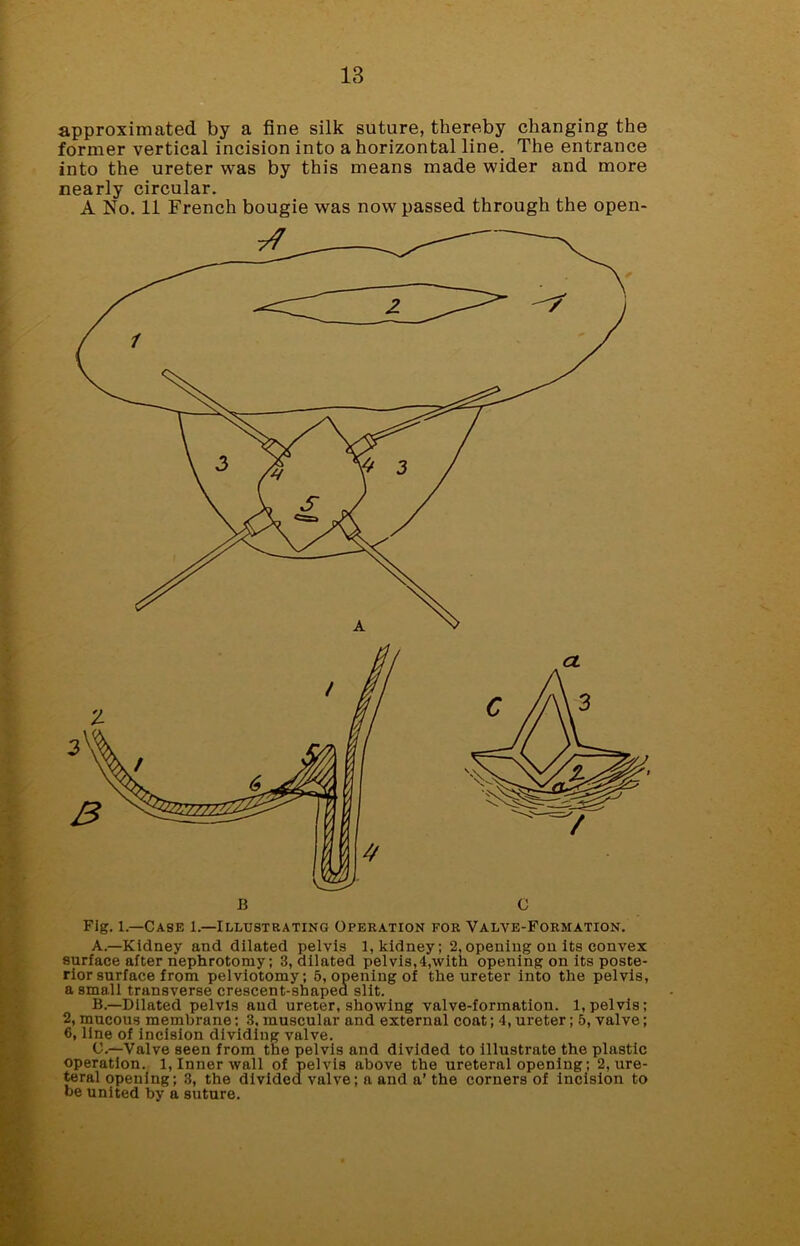 approximated by a fine silk suture, thereby changing the former vertical incision into a horizontal line. The entrance into the ureter was by this means made wider and more nearly circular. A No. 11 French bougie was now passed through the open- Flg. l—Case 1.—Illustrating Operation for Valve-Formation. A. —Kidney and dilated pelvis 1, kidney; 2,opening on its convex surface after nephrotomy; 3, dilated pelvis,4,with opening on its poste- rior surface from pelviotomy; 5, opening of the ureter into the pelvis, a small transverse crescent-shaped slit. B. —Dilated pelvis and ureter, showing valve-formation. 1, pelvis; 2, mucous membrane; 3, muscular and external coat; 4, ureter; 5, valve; 6, line of incision dividing valve. C. —Valve seen from the pelvis and divided to illustrate the plastic operation. 1, Inner wall of pelvis above the ureteral opening; 2, ure- teral opening; 3, the divided valve; a and a’ the corners of incision to he united by a suture.