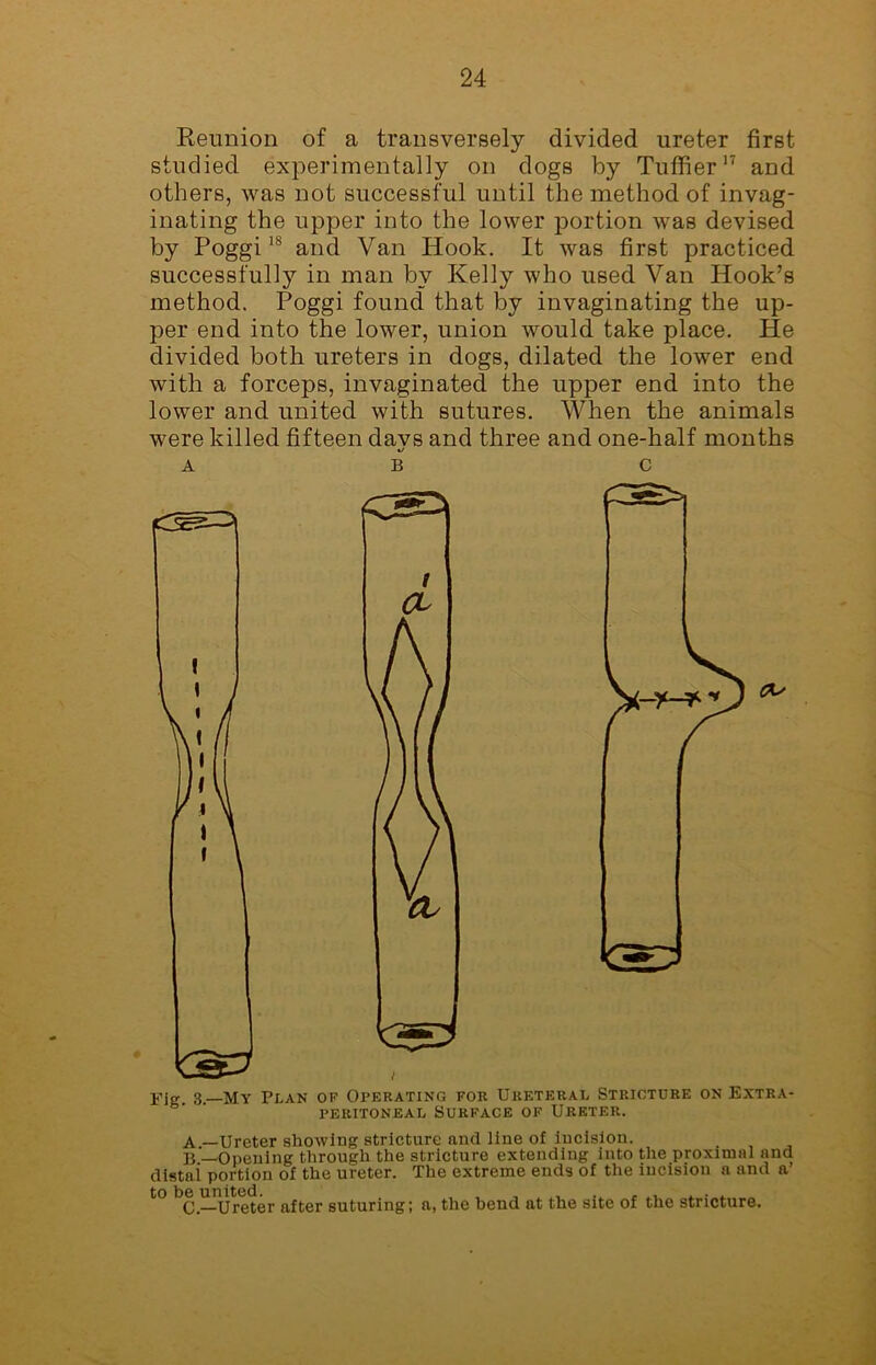 Reunion of a transversely divided ureter first studied experimentally on dogs by Tuffier17 and others, was not successful until the method of invag- inating the upper into the lower portion was devised by Poggi18 and Van Hook. It was first practiced successfully in man by Kelly who used Van Hook’s method. Poggi found that by invaginating the up- per end into the lower, union would take place. He divided both ureters in dogs, dilated the lower end with a forceps, invaginated the upper end into the lower and united with sutures. When the animals were killed fifteen davs and three and one-half months a b c A —Ureter showing stricture and line of incision. B —Opening through the stricture extending into the proximal and distai portion of the ureter. The extreme ends of the incision a and a to be united^r sutUring; a, the bend at the site of the stricture.