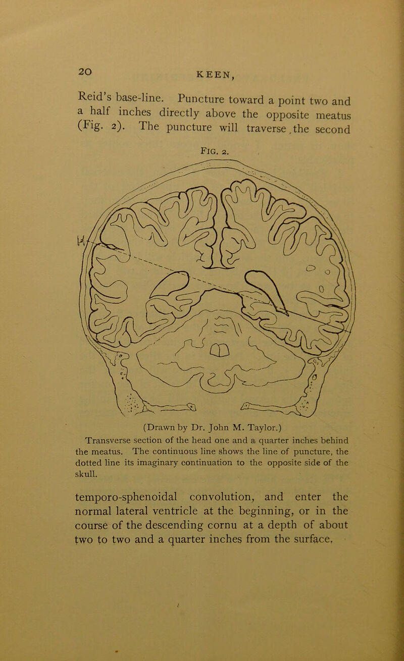 Z{J KEEN, Reid’s base-line. Puncture toward a point two and a half inches directly above the opposite meatus (Fig. 2). The puncture will traverse.the second Fig. 2. (Drawn by Dr. John M. Taylor.) Transverse section of the head one and a quarter inches behind the meatus. The continuous line shows the line of puncture, the dotted line its imaginary continuation to the opposite side of the skull. temporo-sphenoidal convolution, and enter the normal lateral ventricle at the beginning, or in the course of the descending cornu at a depth of about two to two and a quarter inches from the surface.