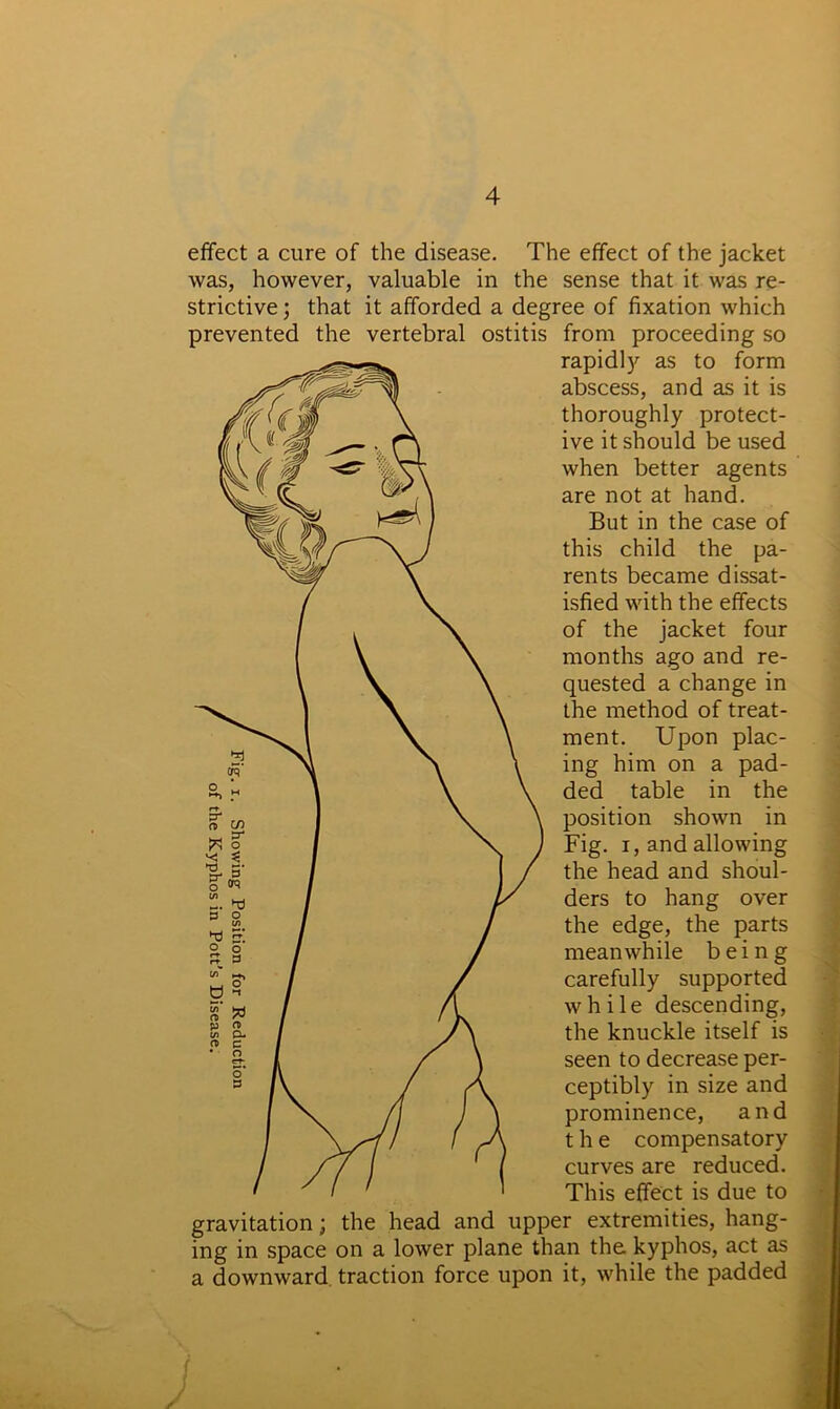 effect a cure of the disease, was, however, valuable The effect of the jacket in the sense that it was re- strictive ; that it afforded a degree of fixation which prevented the vertebral ostitis from proceeding so rapidly as to form abscess, and as it is thoroughly protect- ive it should be used when better agents are not at hand. But in the case of this child the pa- rents became dissat- isfied with the effects of the jacket four months ago and re- quested a change in the method of treat- ment. Upon plac- ing him on a pad- ded table in the position shown in Fig. i, and allowing the head and shoul- ders to hang over the edge, the parts meanwhile being carefully supported while descending, the knuckle itself is seen to decrease per- ceptibly in size and prominence, and the compensatory curves are reduced. This effect is due to gravitation; the head and upper extremities, hang- ing in space on a lower plane than the kyphos, act as a downward traction force upon it, while the padded