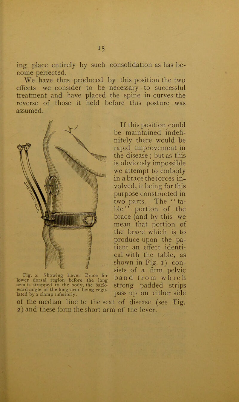 ing place entirely by such consolidation as has be- come perfected. We have thus produced by this position the tvvp effects we consider to be necessary to successful treatment and have placed the spine in curves the reverse of those it held before this posture was assumed. ward angle of the long arm being regu- lated by a clamp interiorly. If this position could be maintained indefi- nitely there would be rapid improvement in the disease • but as this is obviously impossible we attempt to embody in a brace the forces in- volved, it being for this purpose constructed in two parts. The “ ta- ble ” portion of the brace (and by this we mean that portion of the brace which is to produce upon the pa- tient an effect identi- cal with the table, as shown in Fig. i) con- sists of a firm pelvic band from which strong padded strips pass up on either side of the median line to the seat of disease (see Fig. 2) and these form the short arm of the lever.
