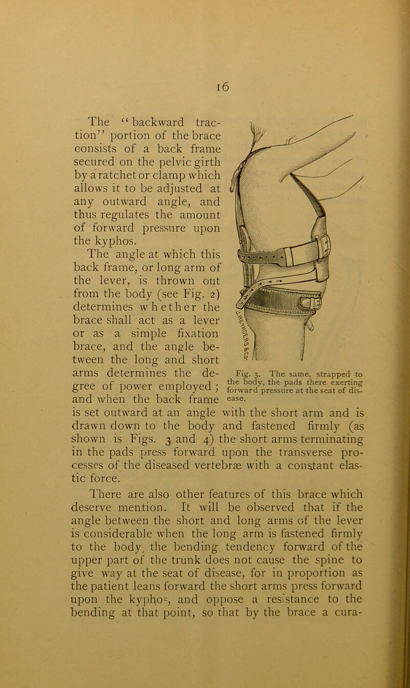 The “ backward trac- tion” portion of the brace consists of a back frame secured on the pelvic girth by a ratchet or clamp which allows it to be adjusted at any outward angle, and thus regulates the amount of forward pressure upon the kyphos. The angle at which this back frame, or long arm of the lever, is thrown out from the body (see Fig. 2) determines whether the brace shall act as a lever or as a simple fixation brace, and the angle be- tween the long and short arms determines the de- gree of power employed ; and when the back frame is set outward at an angle with the short arm and is drawn down to the body and fastened firmly (as shown is Figs. 3 and 4) the short arms terminating in the pads press forward upon the transverse pro- cesses of the diseased vertebrae with a constant elas- tic force. Fig. 3. The same, strapped to the body, the pads there exerting forward pressure at the seat of dis- ease. There are also other features of this brace which deserve mention. It will be observed that if the angle between the short and long arms of the lever is considerable when the long arm is fastened firmly to the body, the bending tendency forward of the upper part of the trunk does not cause the spine to give way at the seat of disease, for in proportion as the patient leans forward the short arms press forward upon the kypfyo-, and oppose a resistance to the bending at that point, so that by the brace a cura-