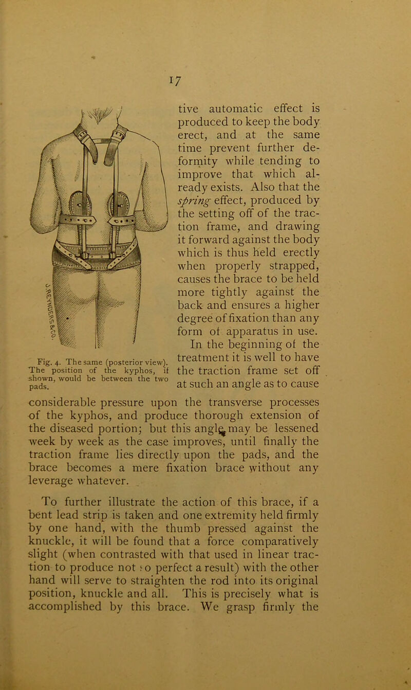 tive automatic effect is produced to keep the body erect, and at the same time prevent further de- formity while tending to improve that which al- ready exists. Also that the spring effect, produced by the setting off of the trac- tion frame, and drawing it forward against the body which is thus held erectly when properly strapped, causes the brace to be held more tightly against the back and ensures a higher degree of fixation than any form of apparatus in use. In the beginning of the treatment it is well to have the traction frame set off at such an angle as to cause considerable pressure upon the transverse processes of the kyphos, and produce thorough extension of the diseased portion; but this angl^may be lessened week by week as the case improves, until finally the traction frame lies directly upon the pads, and the brace becomes a mere fixation brace without any leverage whatever. To further illustrate the action of this brace, if a bent lead strip is taken and one extremity held firmly by one hand, with the thumb pressed against the knuckle, it will be found that a force comparatively slight (when contrasted with that used in linear trac- tion to produce not to perfect a result) with the other hand will serve to straighten the rod into its original position, knuckle and all. This is precisely what is accomplished by this brace. We grasp firmly the Fig. 4. The same (posterior view). The position of the kyphos, if shown, would be between the two pads.