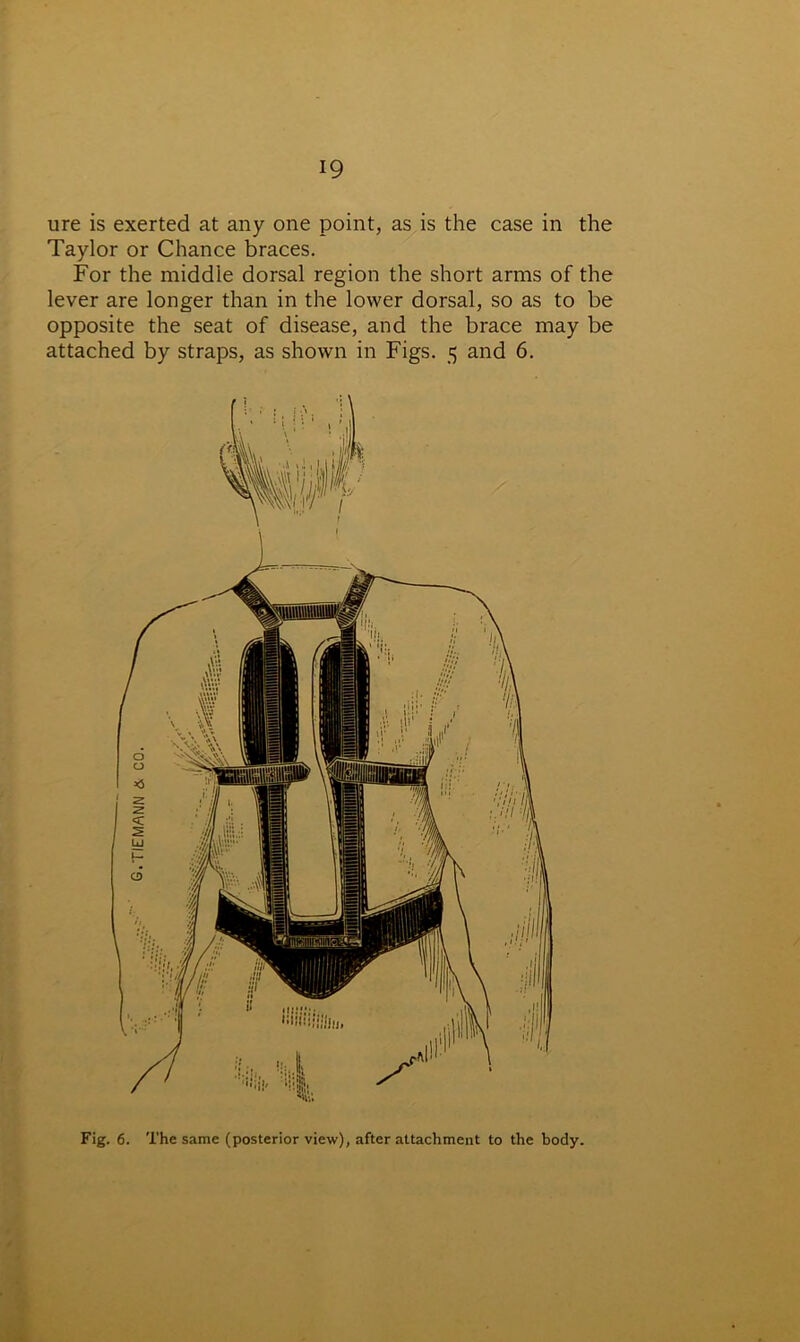 ure is exerted at any one point, as is the case in the Taylor or Chance braces. For the middle dorsal region the short arms of the lever are longer than in the lower dorsal, so as to be opposite the seat of disease, and the brace may be attached by straps, as shown in Figs. 5 and 6. Fig. 6. The same (posterior view), after attachment to the body.