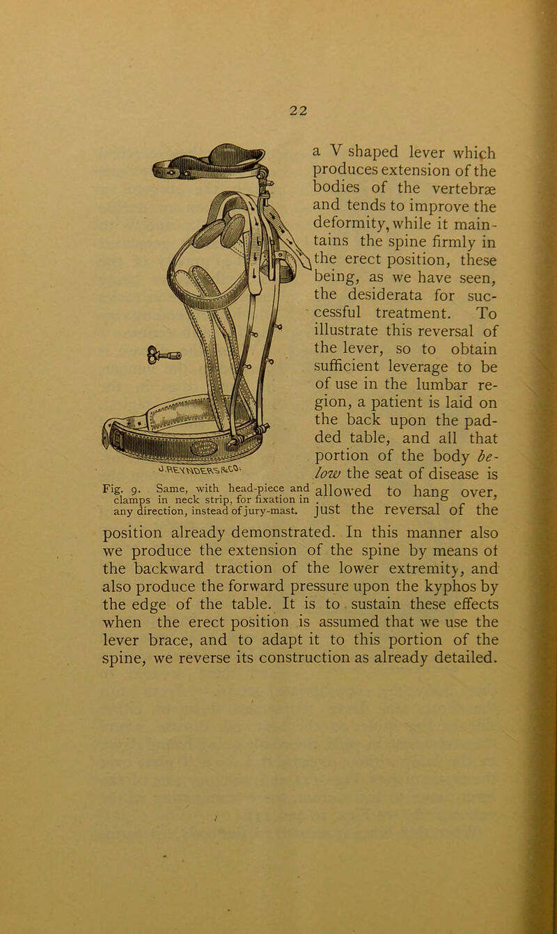 a V shaped lever which produces extension of the bodies of the vertebrae and tends to improve the deformity, while it main- tains the spine firmly in the erect position, these being, as we have seen, the desiderata for suc- cessful treatment. To illustrate this reversal of the lever, so to obtain sufficient leverage to be of use in the lumbar re- gion, a patient is laid on the back upon the pad- ded table, and all that _ _ portion of the body be- low the seat of disease is Fig 9. Same, with head-piece and allowed to hang Over, clamps in neck strip, for fixation in . ° J any direction, instead of jury-mast. JUSt the reversal Of the position already demonstrated. In this manner also we produce the extension of the spine by means ot the backward traction of the lower extremity, and also produce the forward pressure upon the kyphos by the edge of the table. It is to sustain these effects when the erect position is assumed that we use the lever brace, and to adapt it to this portion of the spine, we reverse its construction as already detailed.