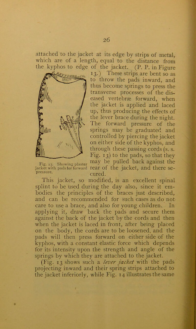 2 6 'VERS—CO. attached to the jacket at its edge by strips of metal, which are of a length, equal to the distance from the kyphos to edge of the jacket. (P. P. in Figure 13.) These strips are bent so as to throw the pads inward, and thus become springs to press the transverse processes of the dis- eased vertebrae forward, when the jacket is applied and laced up, thus producing the effects of the lever brace during the night. The forward pressure of the springs may be graduated and controlled by piercing the jacket on either side of the kyphos, and through these passing cords (s. s. Fig. 13) to the pads, so that they showin- piaster may be pulled back against the jacket with padsfo“forward rear of the jacket, and there se- pressure- cured. This jacket, so modified, is an excellent spinal splint to be used during the day also, since it em- bodies the principles of the braces just described, and can be recommended for such cases as do not care to use a brace, and also for young children. In applying it, draw back the pads and secure them against the back of the jacket by the cords and then when the jacket is laced in front, after being placed on the body, the cords are to be loosened, and the pads will then press forward on either side of the kyphos, with a constant elastic force which depends for its intensity upon the strength and angle of the springs by which they are attached to the jacket. (Fig. 13 shows such a lever jacket with the pads projecting inward and their spring strips attached to the jacket inferiorly, while Fig. 14 illustrates the same