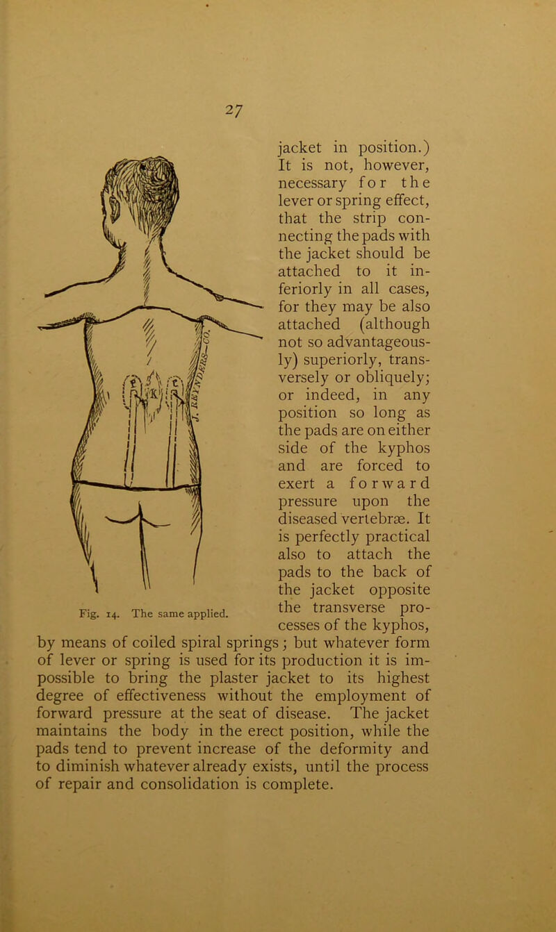 jacket in position.) It is not, however, necessary for the lever or spring effect, that the strip con- necting the pads with the jacket should be attached to it in- teriorly in all cases, for they may be also attached (although not so advantageous- ly) superiorly, trans- versely or obliquely; or indeed, in any position so long as the pads are on either side of the kyphos and are forced to exert a forward pressure upon the diseased vertebrae. It is perfectly practical also to attach the pads to the back of the jacket opposite the transverse pro- cesses of the kyphos, by means of coiled spiral springs; but whatever form of lever or spring is used for its production it is im- possible to bring the plaster jacket to its highest degree of effectiveness without the employment of forward pressure at the seat of disease. The jacket maintains the body in the erect position, while the pads tend to prevent increase of the deformity and to diminish whatever already exists, until the process of repair and consolidation is complete. Fig. 14. The same applied.