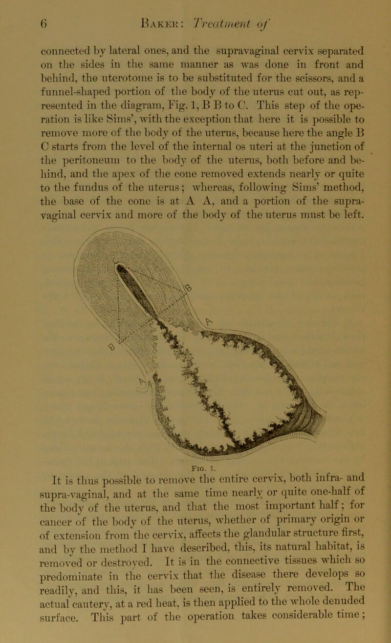 connected by lateral ones, and the supravaginal cervix separated on the sides in the same manner as was done in front and behind, the nterotome is to be substituted for the scissors, and a funnel-shaped portion of the body of the uterus cut out, as rep- resented in the diagram, Fig. 1, B B to C. This step of the ope- ration is like Sims’, with the exception that here it is possible to remove more of the body of the uterus, because here the angle B C starts from the level of the internal os uteri at the junction of the peritoneum to the body of the ntems, botli before and be- liind, and the apex of the cone removed extends nearly or quite to the fundus of the uterus; whereas, following Sims’ method, the base of the cone is at A A, and a portion of the supra- vaginal cervix and moi’e of tlie body of the uterus must be left. Fig. 1. It is thus possible to remove the entire cervix, both infra- and supra-vaginal, and at the same time nearly or quite one-half of the body of the uterus, and that the most important half; for cancer of the body of the uterus, whether of primary origin or of extension from the cervix, affects the glandular structure first, and by the method I have described, this, its natural habitat, is removed or destroyed. It is in the connective tissues which so predominate in the cervix that the disease there develops so readily, and this, it has been seen, is entirely removed. The actual cautery, at a red heat, is then applied to the whole denuded surface. Tliis part of the operation takes considerable time;